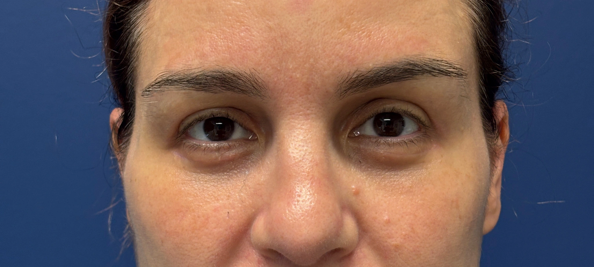 Blepharoplasty-Case--5118 | After Eyelid Surgery 1