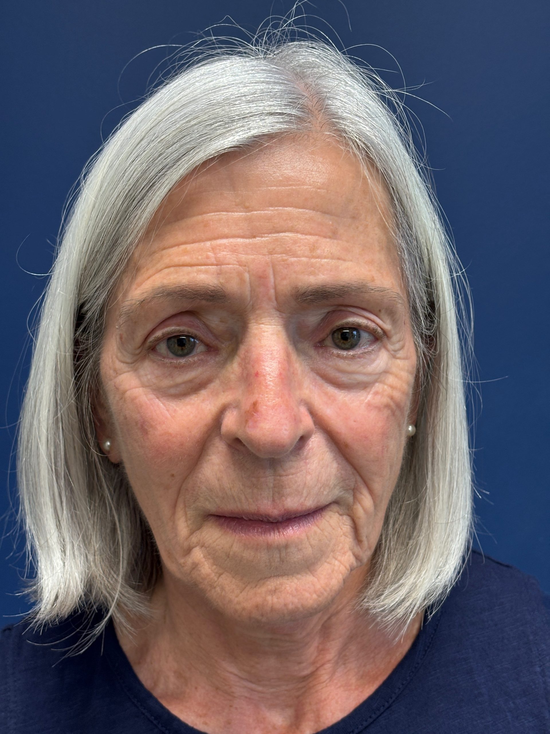 Facelift-Facial-Fat-Grafting-Browlift-Blepharoplasty-Necklift-Case--4176 | Before Brow Lift 1