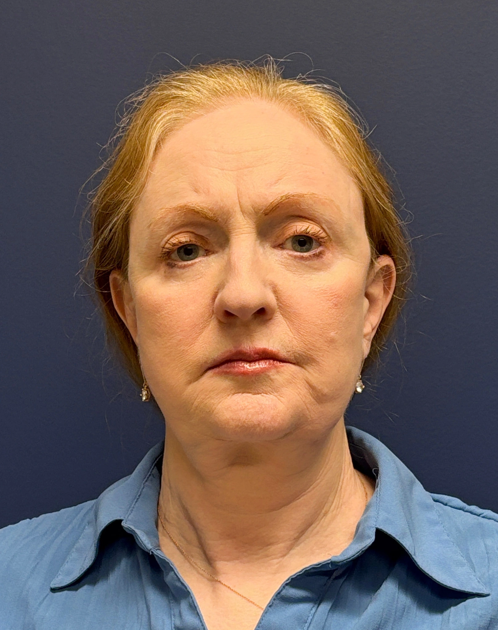 Facelift-and-Facial-Fat-Grafting-Case--3549 | After Facelift 1