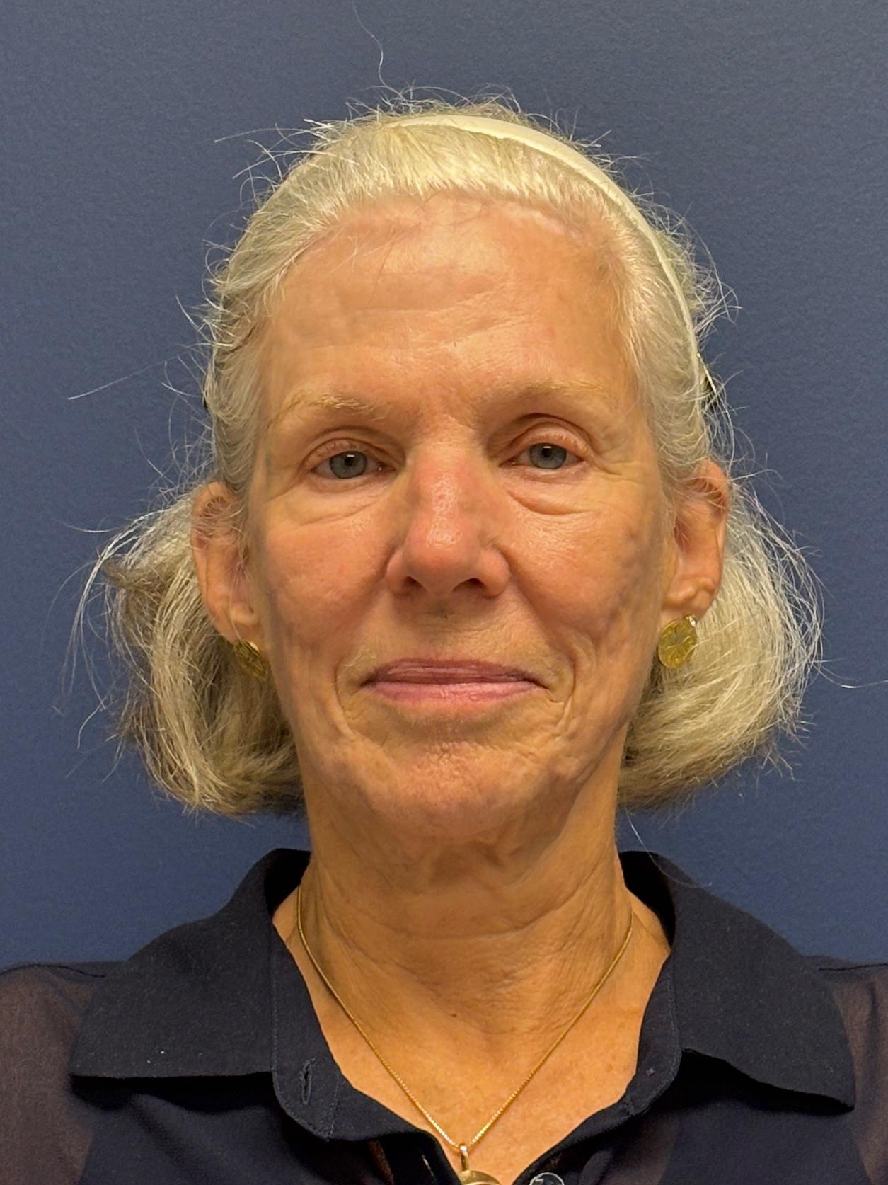 Facelift-Facial-Fat-Grafting-Neck-Lift-Case--1414 | Before Face360 1