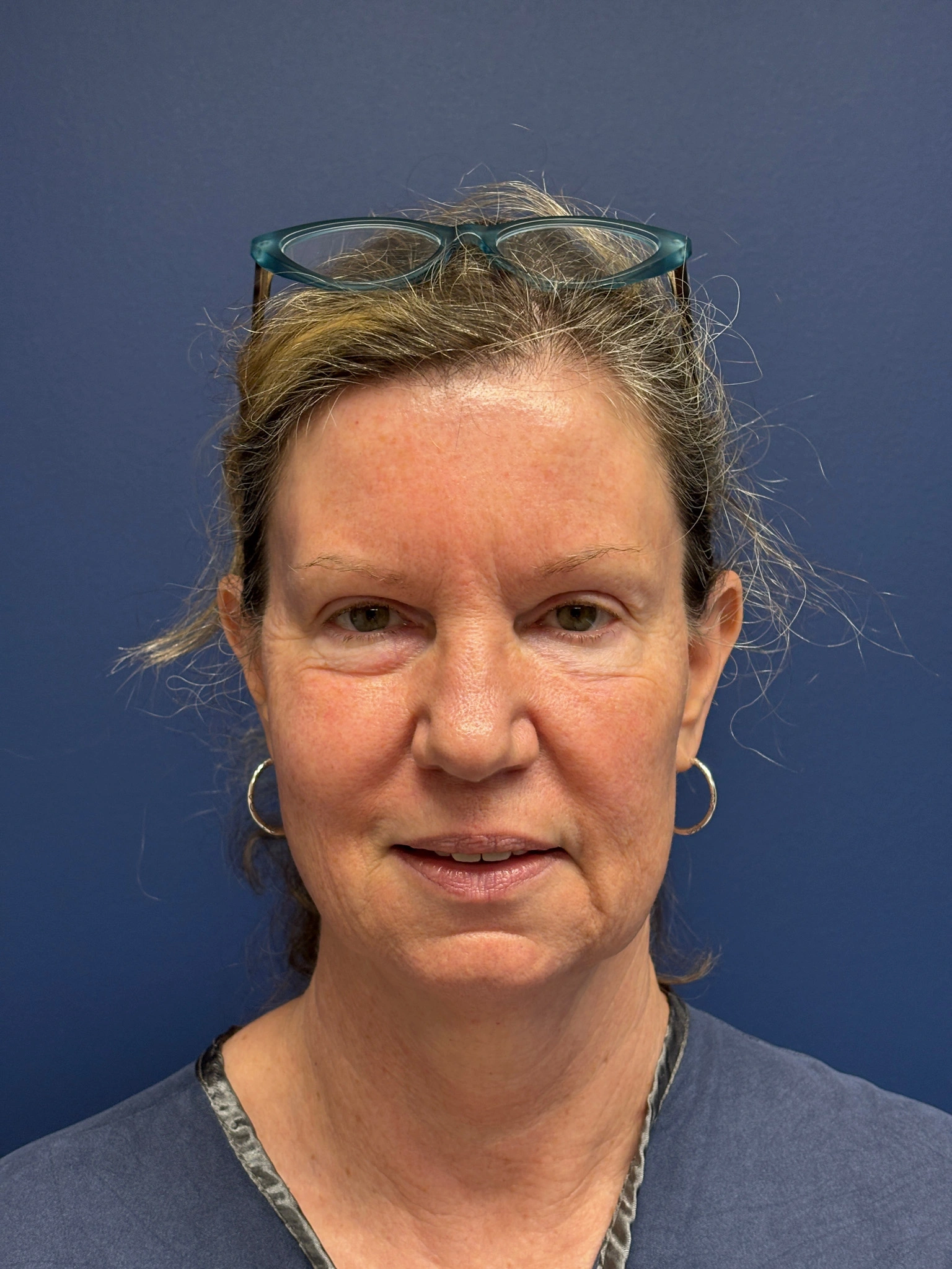 Facelift-Case--2304 | Before Facelift 1