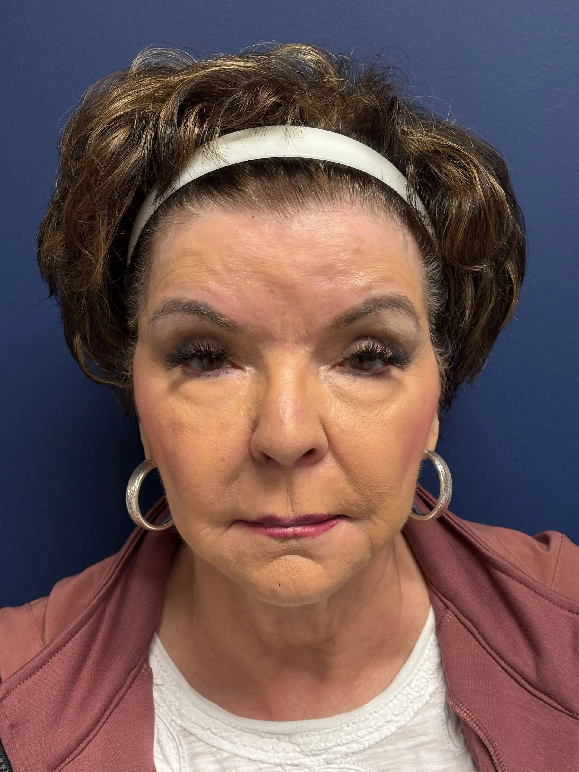 Facelift-Case--6613 | Before Facelift 1