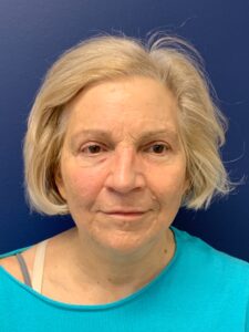 Facelift-Case--3746 | After Dr. Frank Albino 1