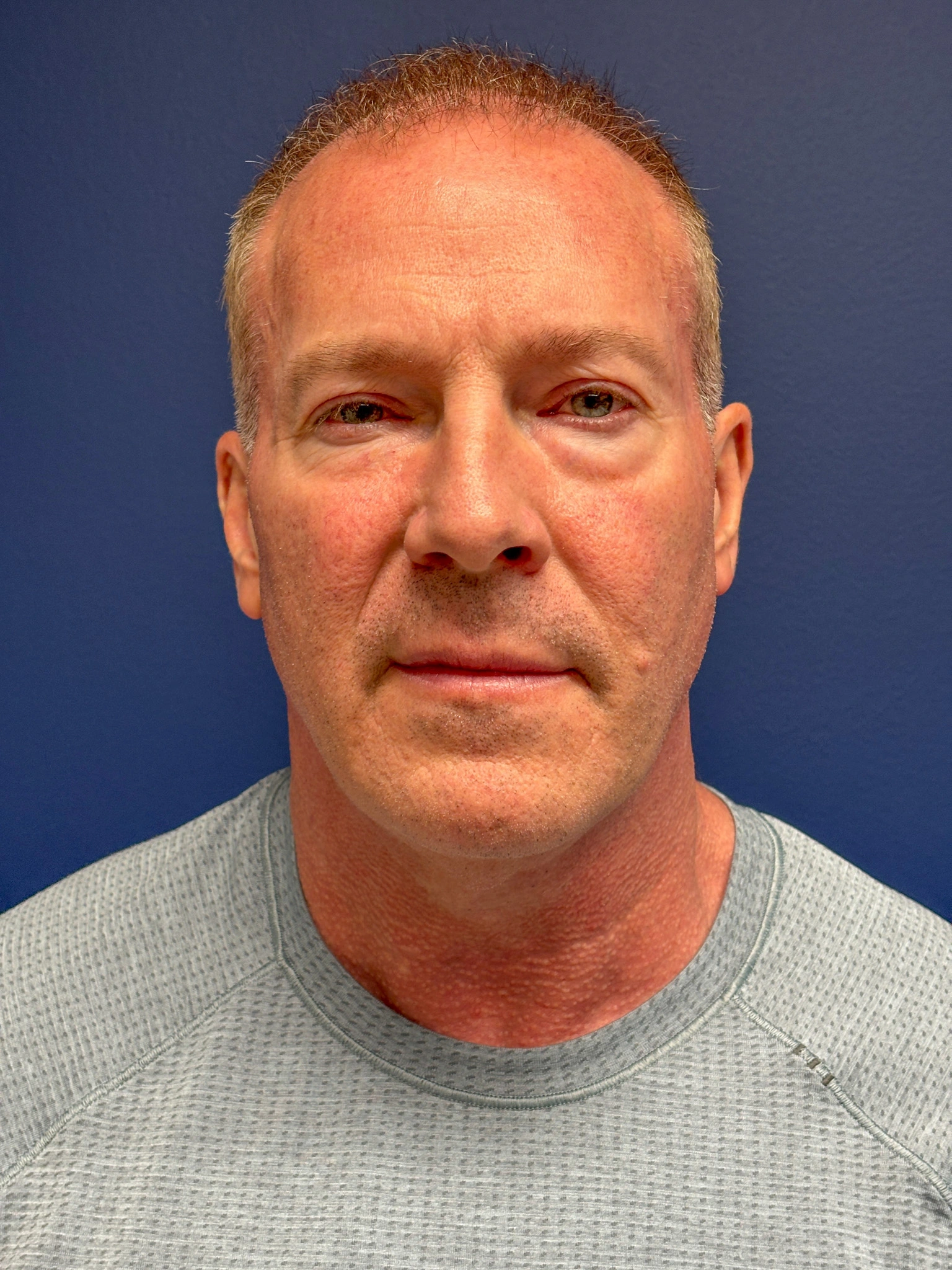 Facelift-Case--5246 | Before Facelift 1