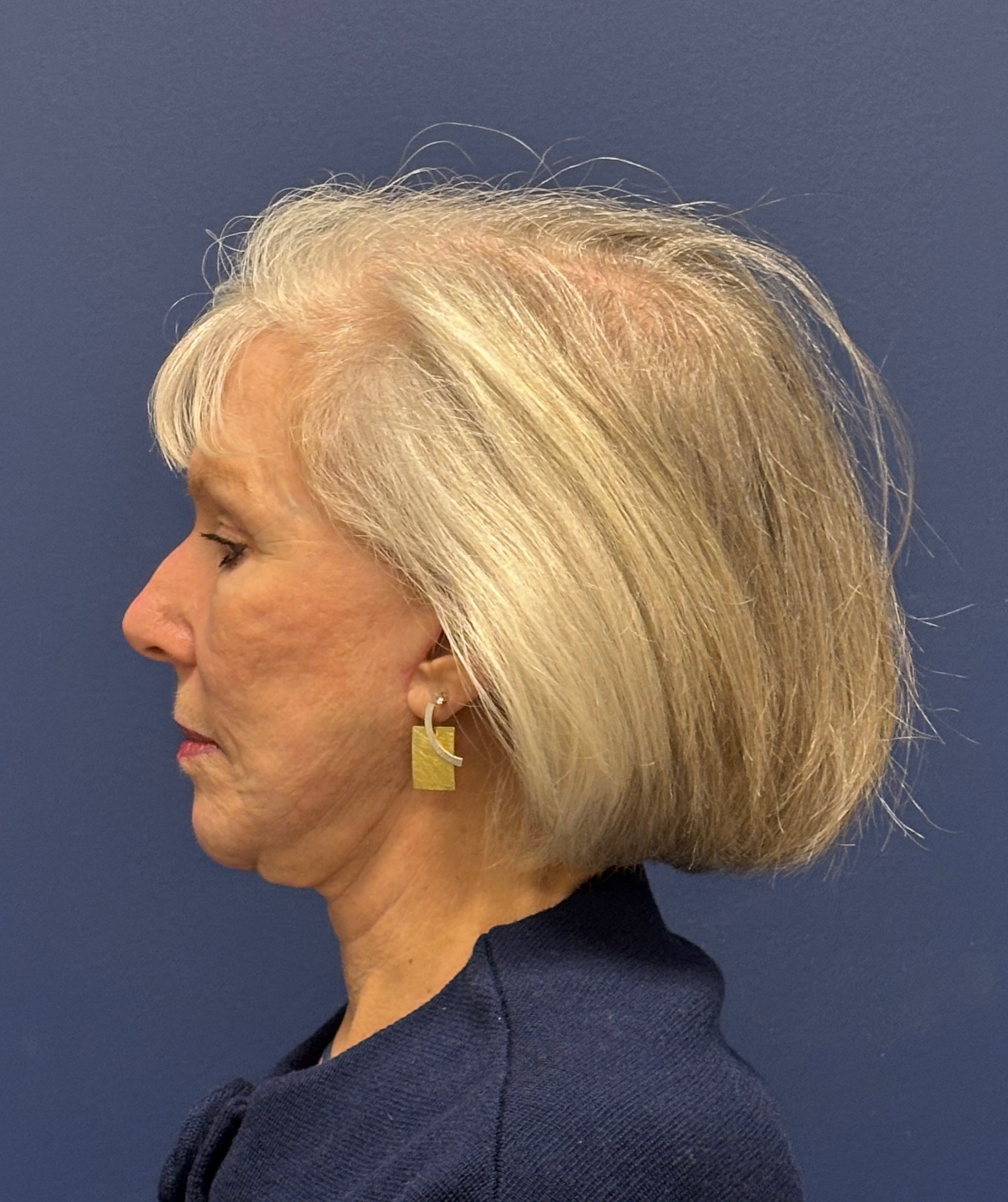 Facelift-Facial-Fat-Grafting-Neck-Lift-Case--1414 | After Face360 2