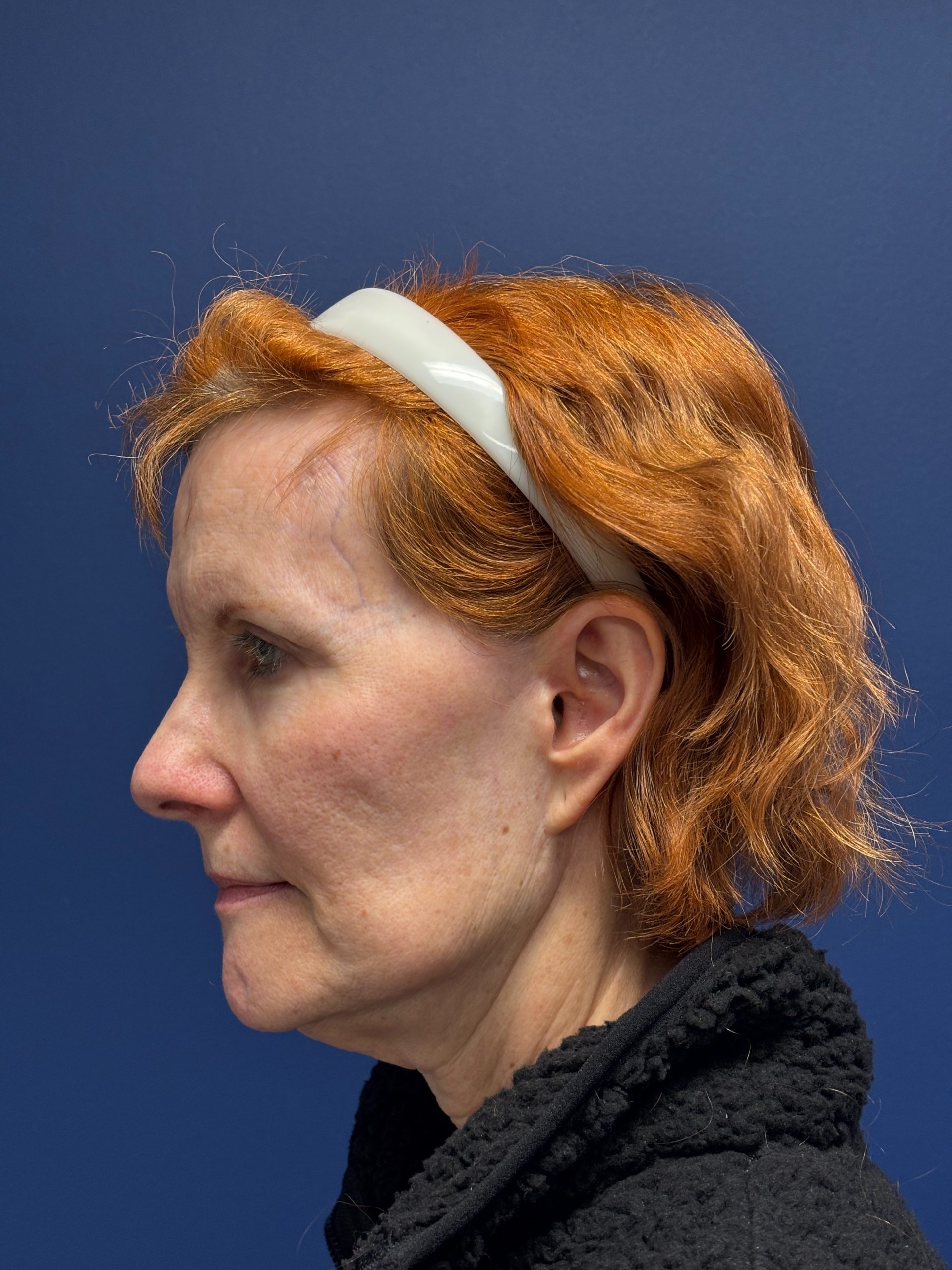 Facelift-Facial-Fat-Grafting-Neck-Lift-Case--6778 | Before Face360 2