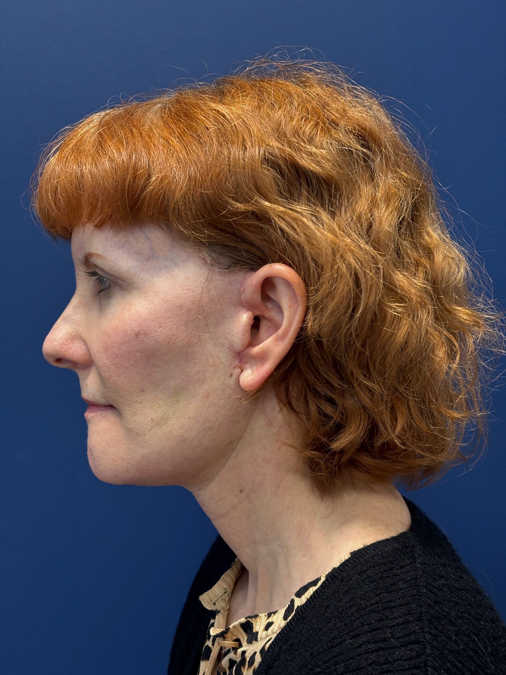 Facelift-Facial-Fat-Grafting-Neck-Lift-Case--6778 | After Face360 2