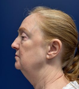 Facelift-Facial-Fat-Graft-Blepharoplasty-Necklift-Case--7934 | Before Face360 2