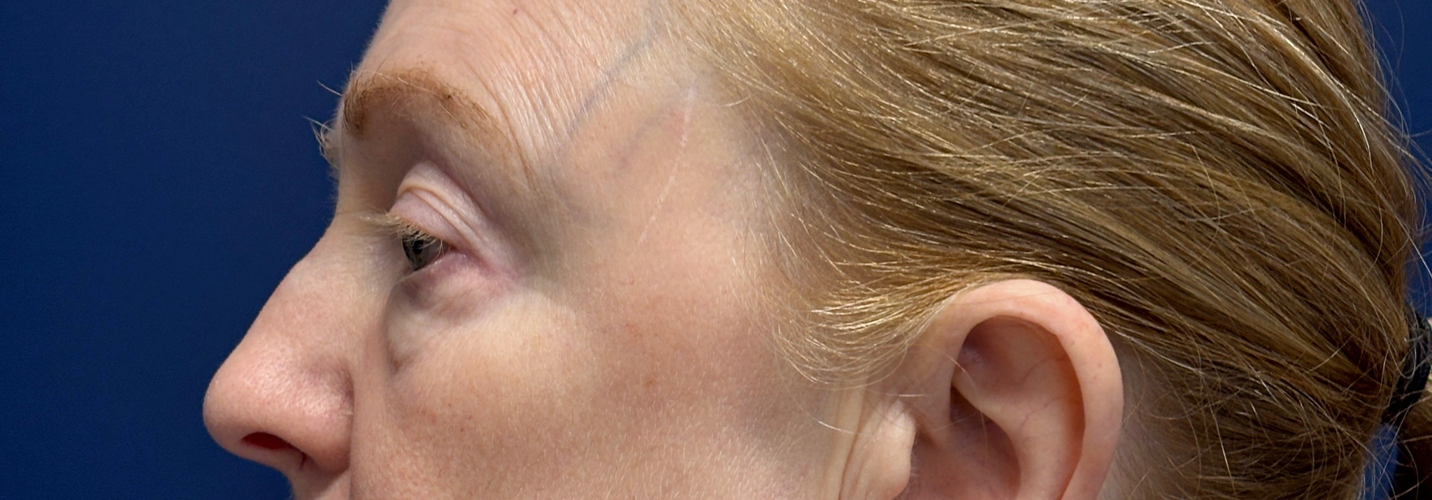 Blepharoplasty-Case--2019 | Before Eyelid Surgery 3