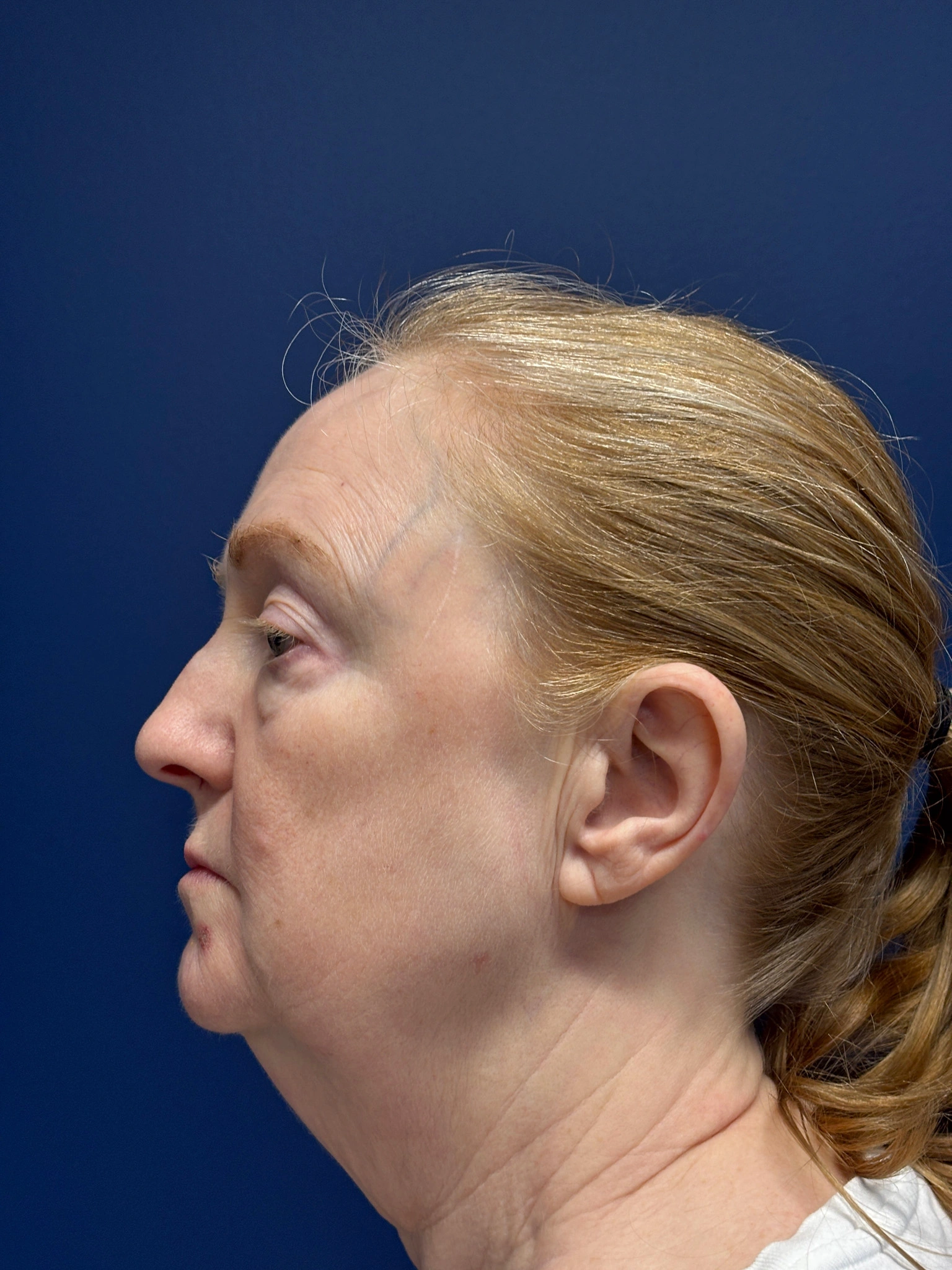 Facelift-and-Facial-Fat-Grafting-Case--3549 | Before Facelift 3
