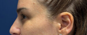 Blepharoplasty-Case--5118 | Before Eyelid Surgery 2