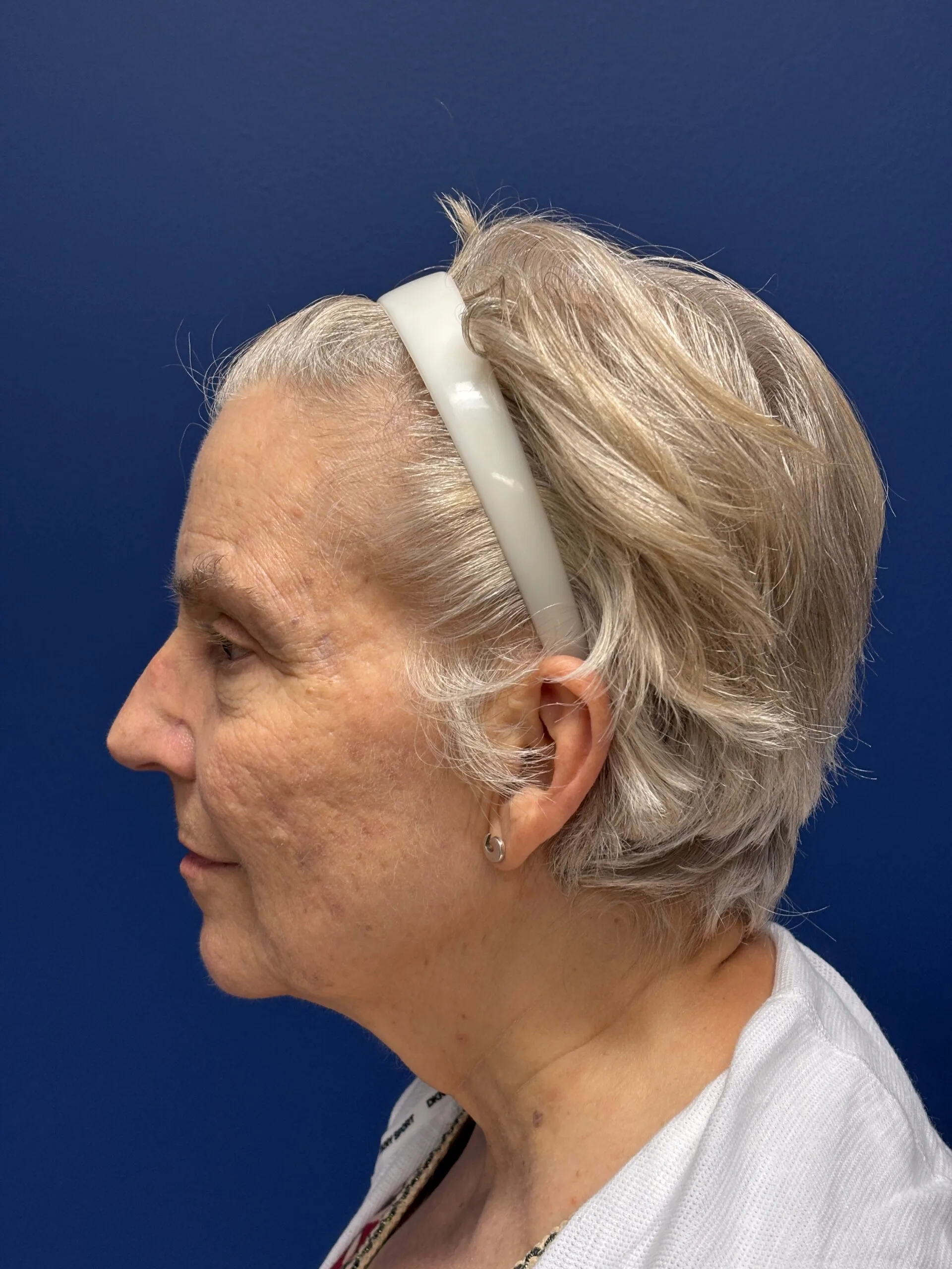 Facelift-Case--3746 | Before Facelift 3