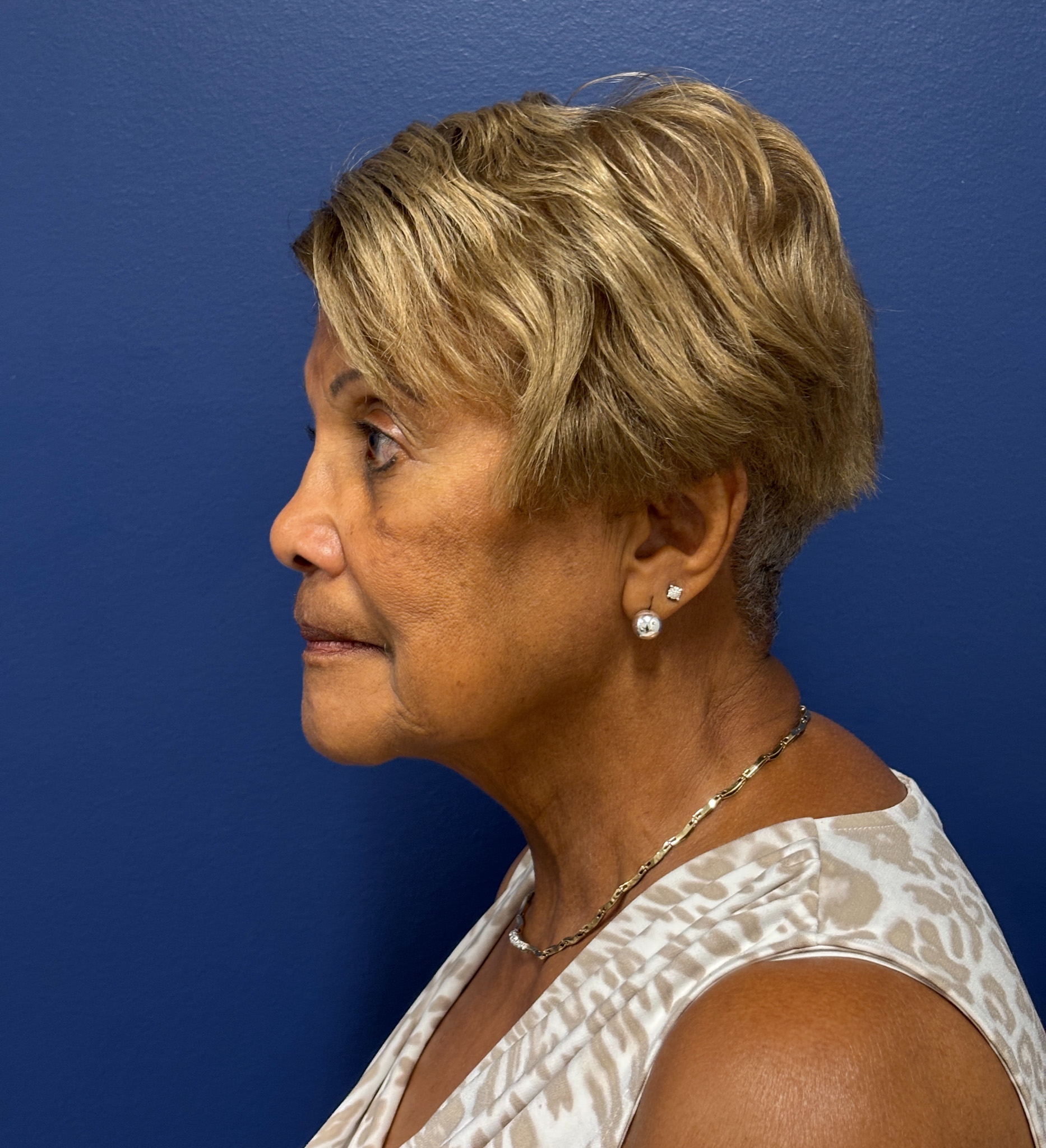 Facelift-Facial-Fat-Graft-Neck-Lift-Case--4262 | Before Face360 3