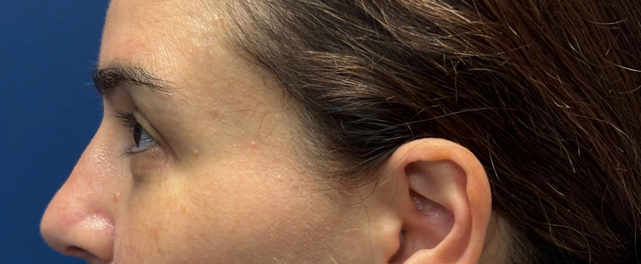 Blepharoplasty-Case--5118 | After Eyelid Surgery 2