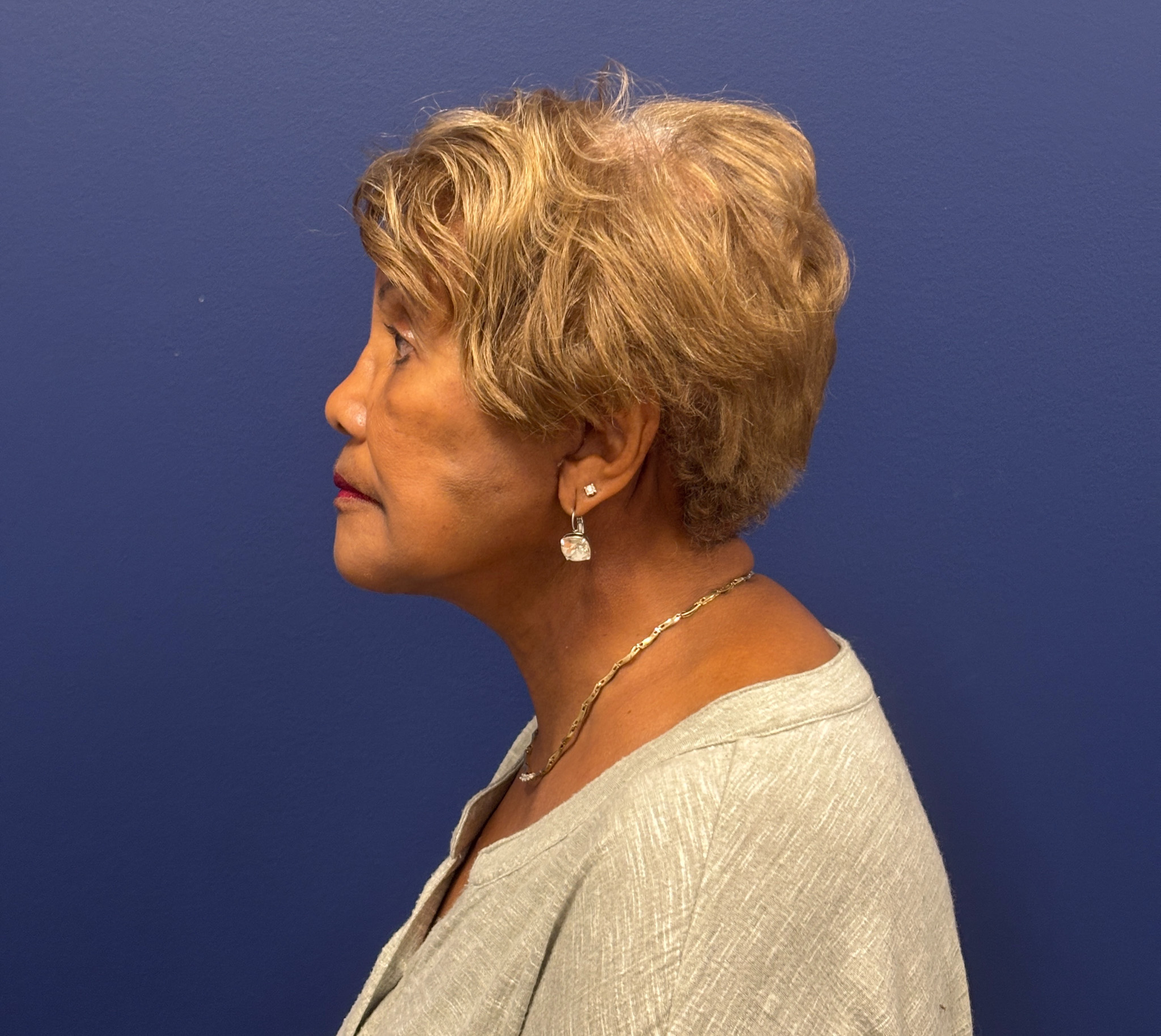 Facelift-Facial-Fat-Graft-Neck-Lift-Case--4262 | After Face360 3