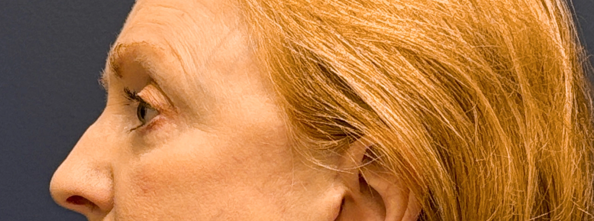 Blepharoplasty-Case--2019 | After Eyelid Surgery 3