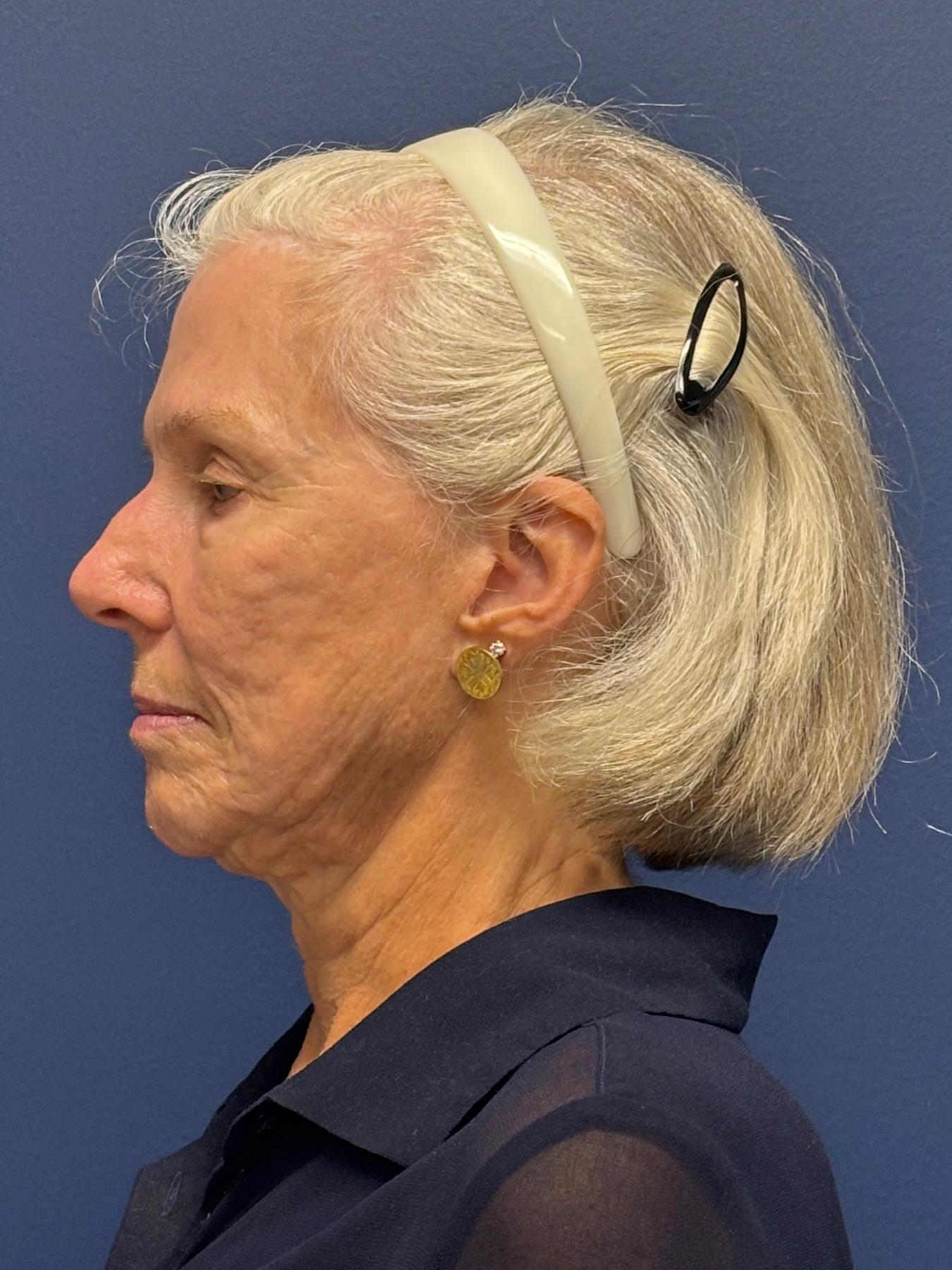 Facelift-Facial-Fat-Grafting-Neck-Lift-Case--1414 | Before Face360 2