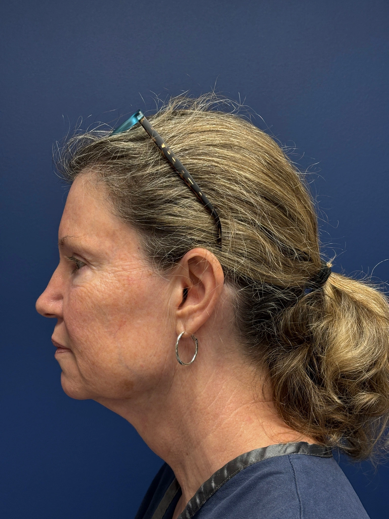 Facelift-Case--2304 | Before Facelift 2