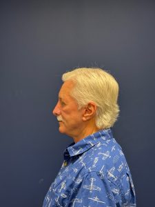 Facelift-Facial-Fat-Graft-Blepheroplasty-Necklift-Case--7796 | After Face360 2