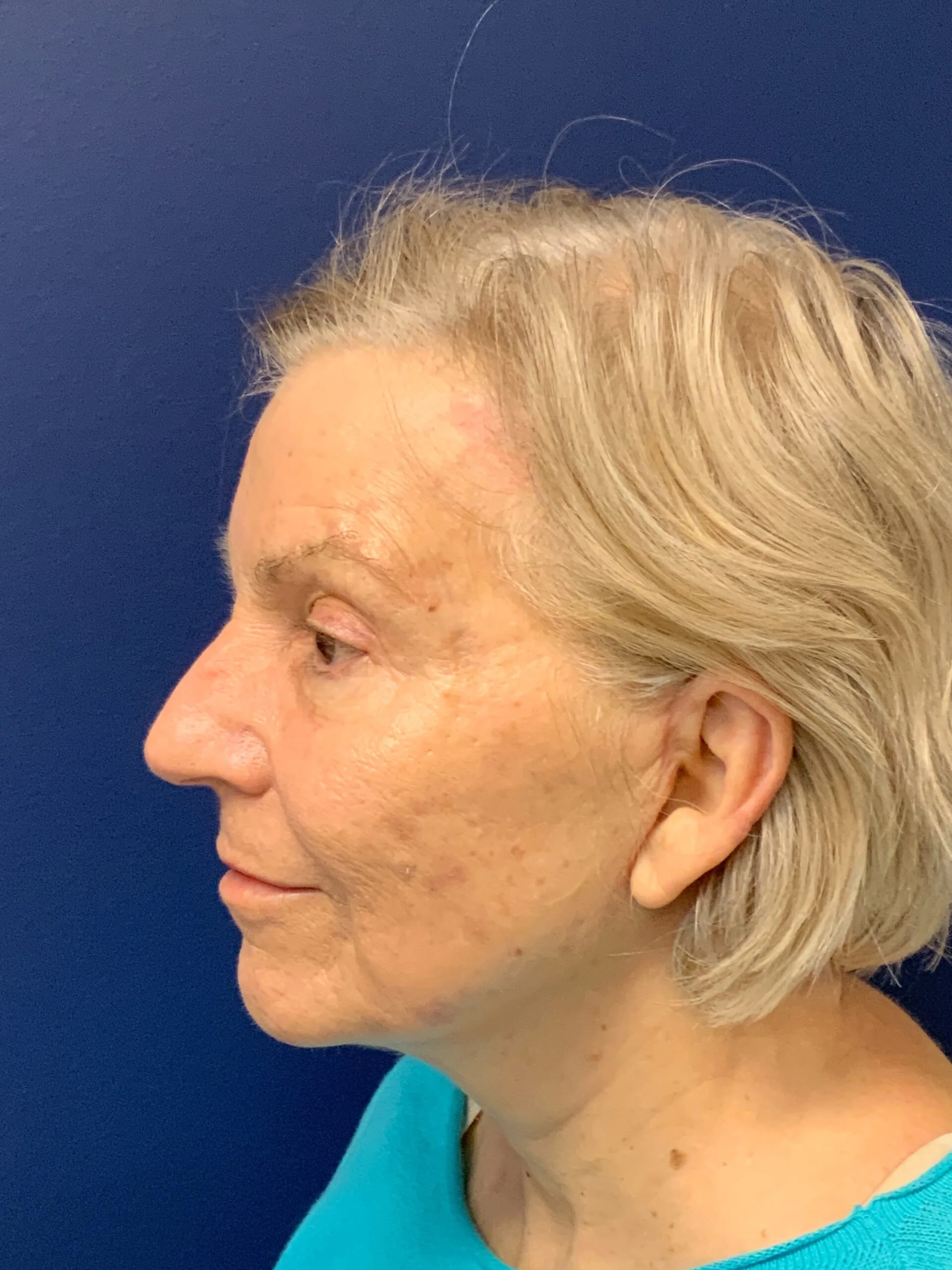 Facelift-Case--3746 | After Facelift 3