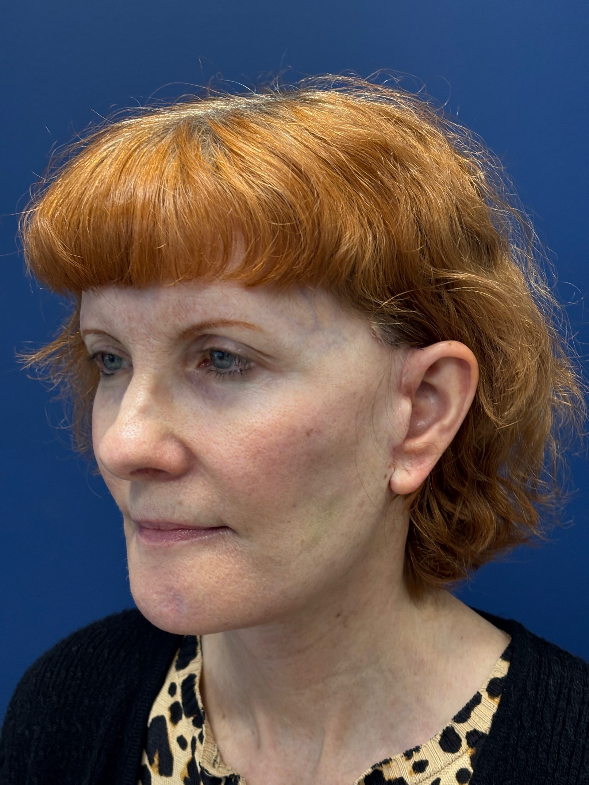 Facelift-Facial-Fat-Grafting-Neck-Lift-Case--6778 | After Face360 4