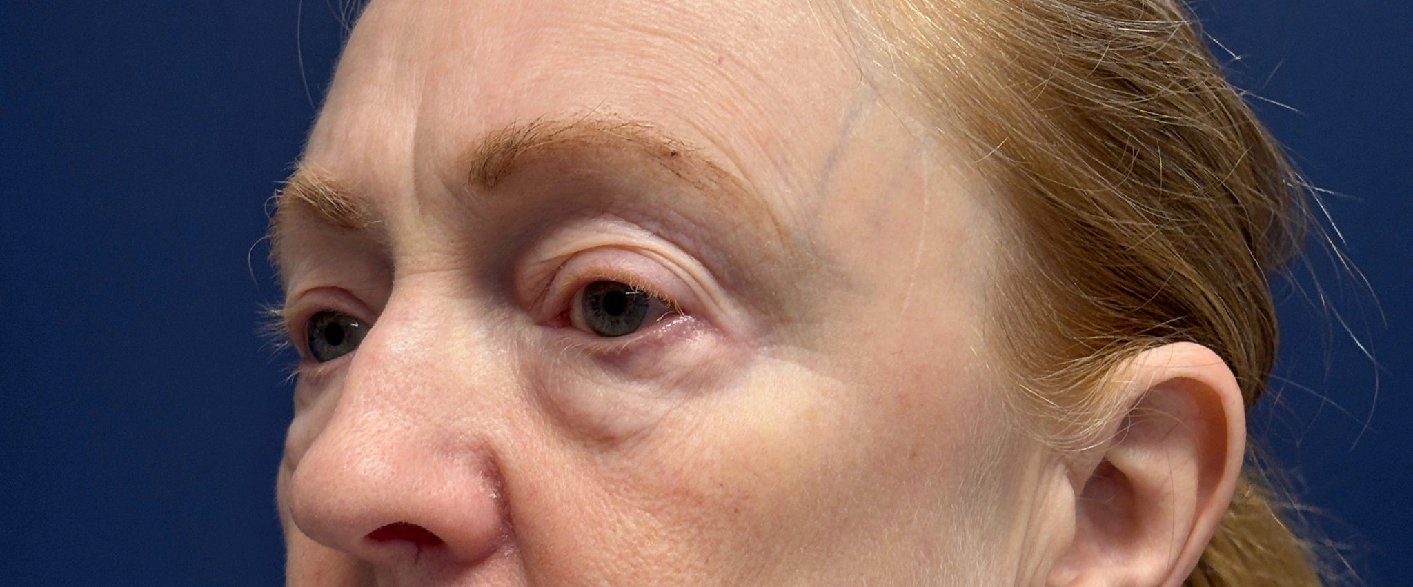 Blepharoplasty-Case--2019 | Before Eyelid Surgery 5