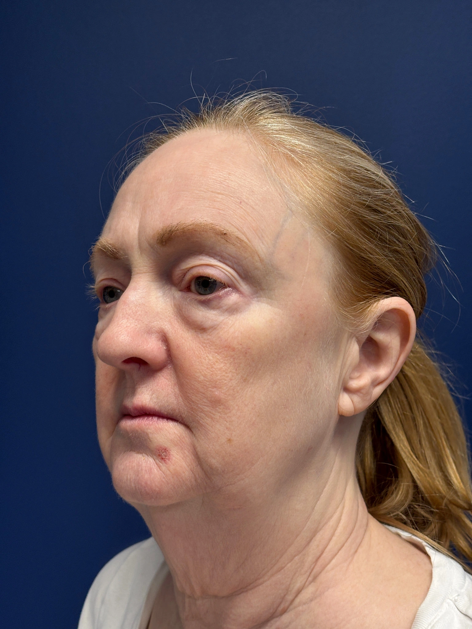 Facelift-and-Facial-Fat-Grafting-Case--3549 | Before Facelift 5