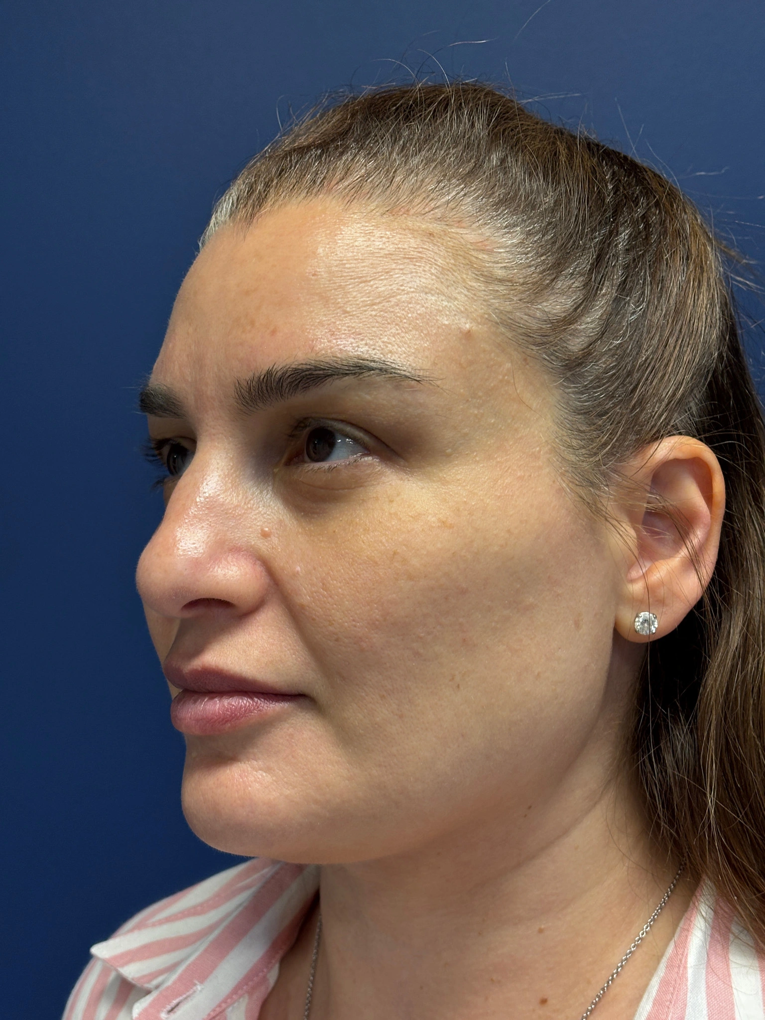 Facelift-and-Facial-Fat-Grafting-Case--7977 | Before Facelift 4