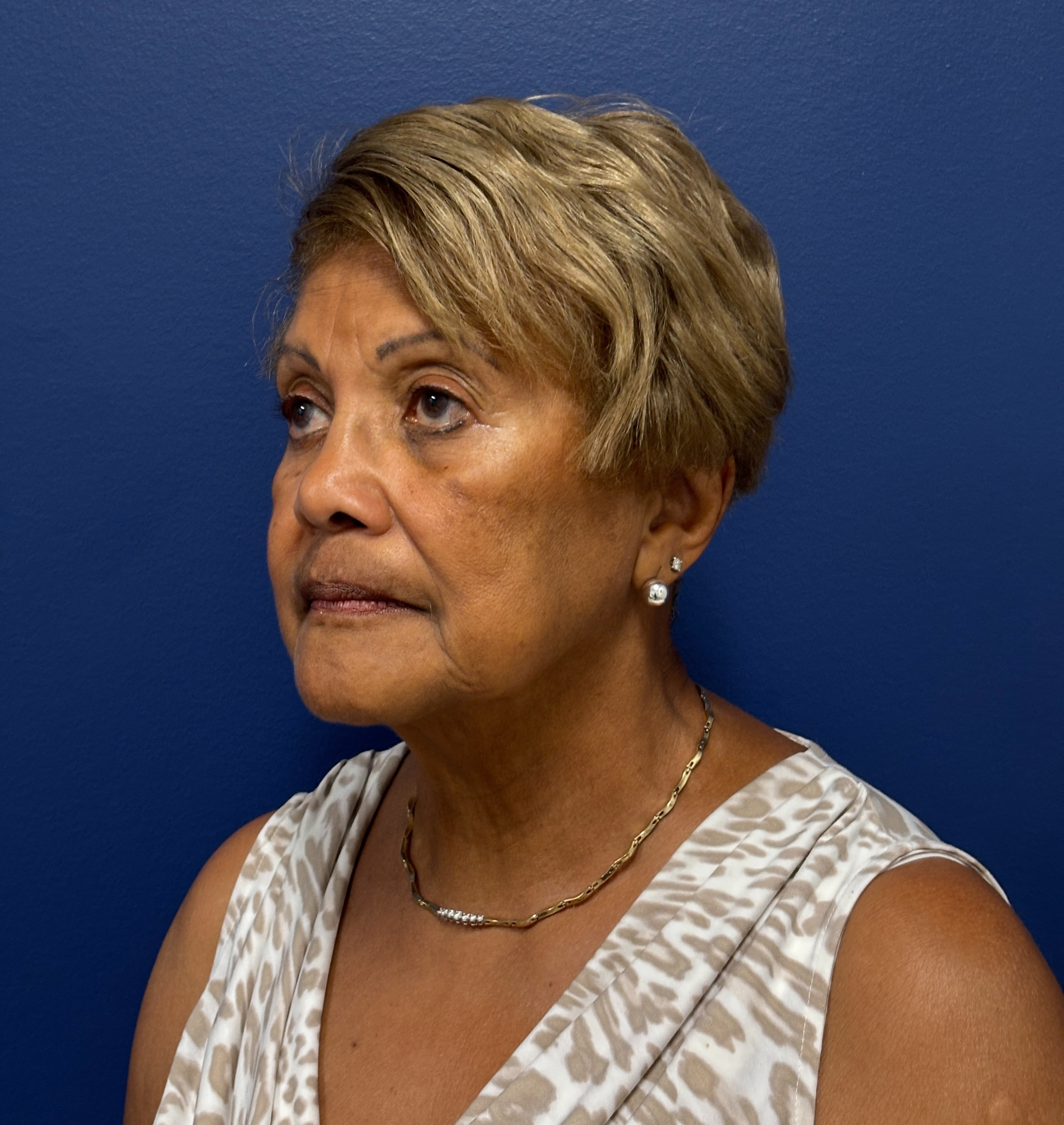 Facelift-Facial-Fat-Graft-Neck-Lift-Case--4262 | Before Face360 5