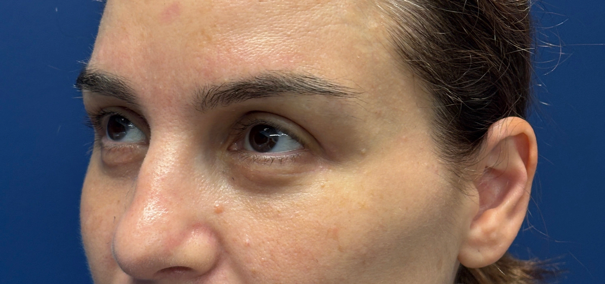 Blepharoplasty-Case--5118 | After Eyelid Surgery 4