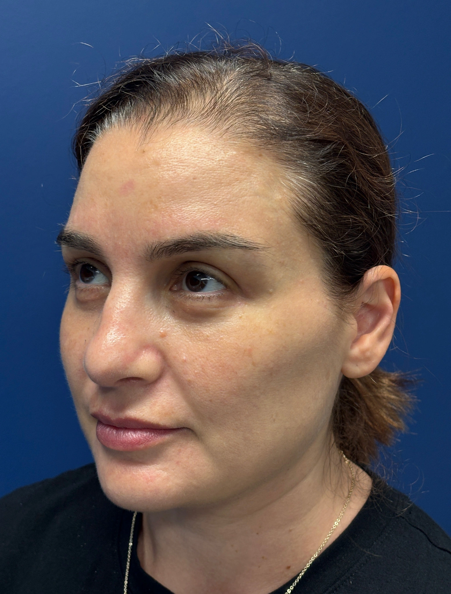 Facelift-and-Facial-Fat-Grafting-Case--7977 | After Facelift 4