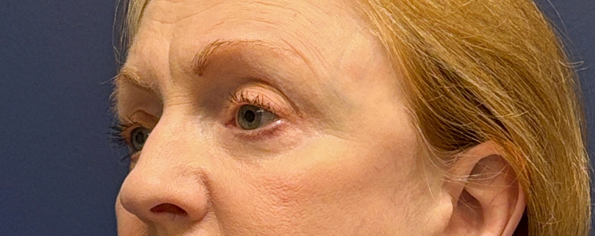 Blepharoplasty-Case--2019 | After Eyelid Surgery 5
