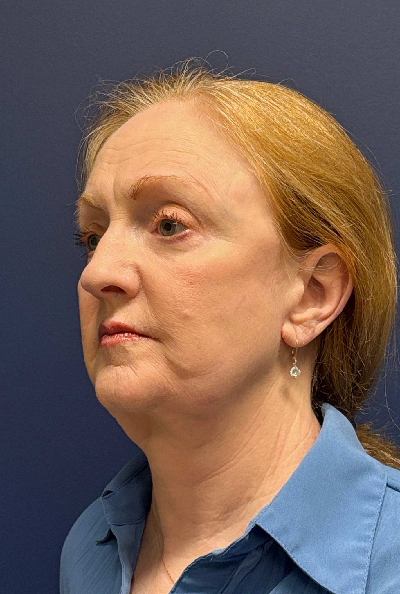 Facelift-and-Facial-Fat-Grafting-Case--3549 | After Facelift 5