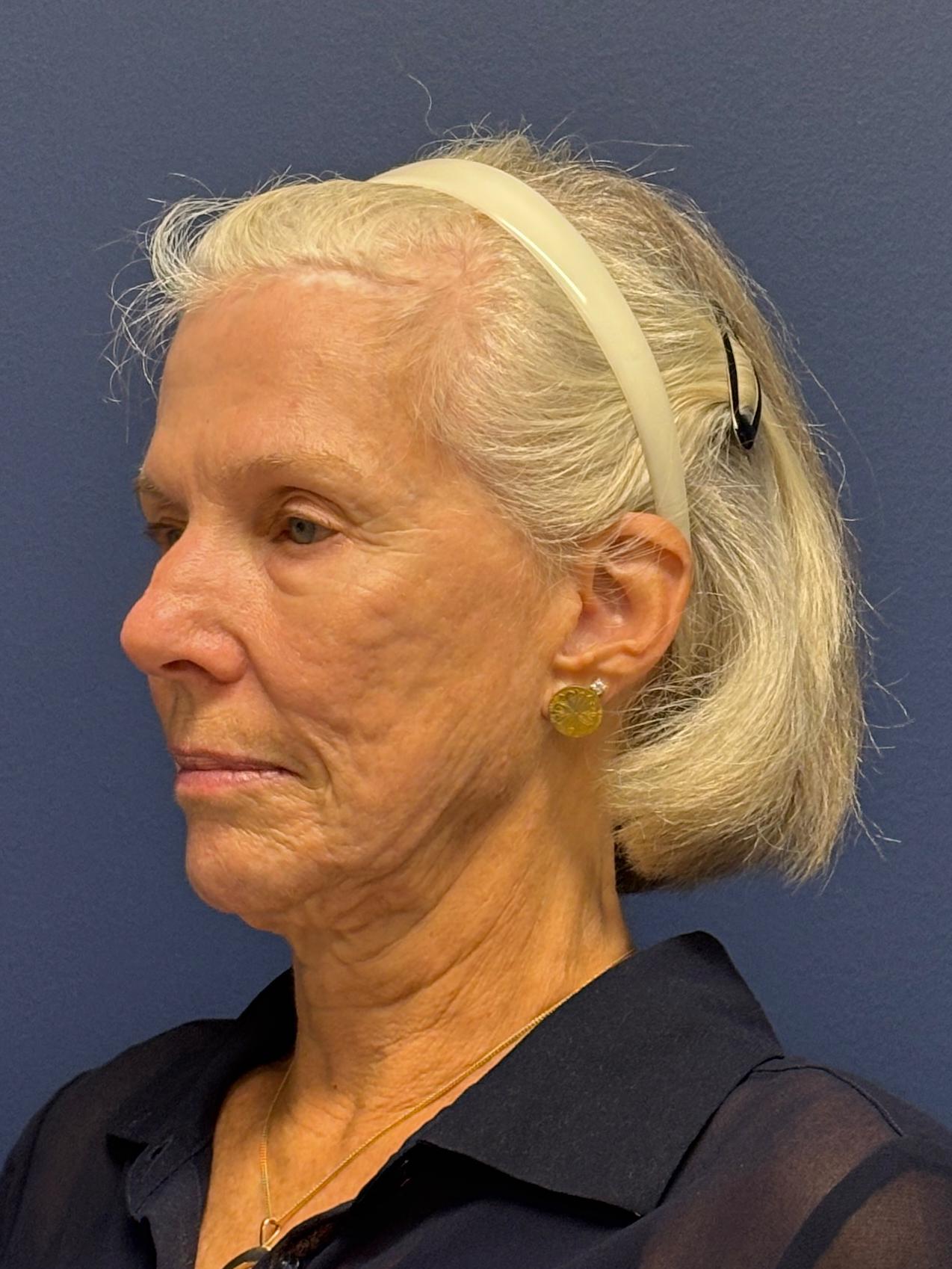Facelift-Facial-Fat-Grafting-Neck-Lift-Case--1414 | Before Face360 4
