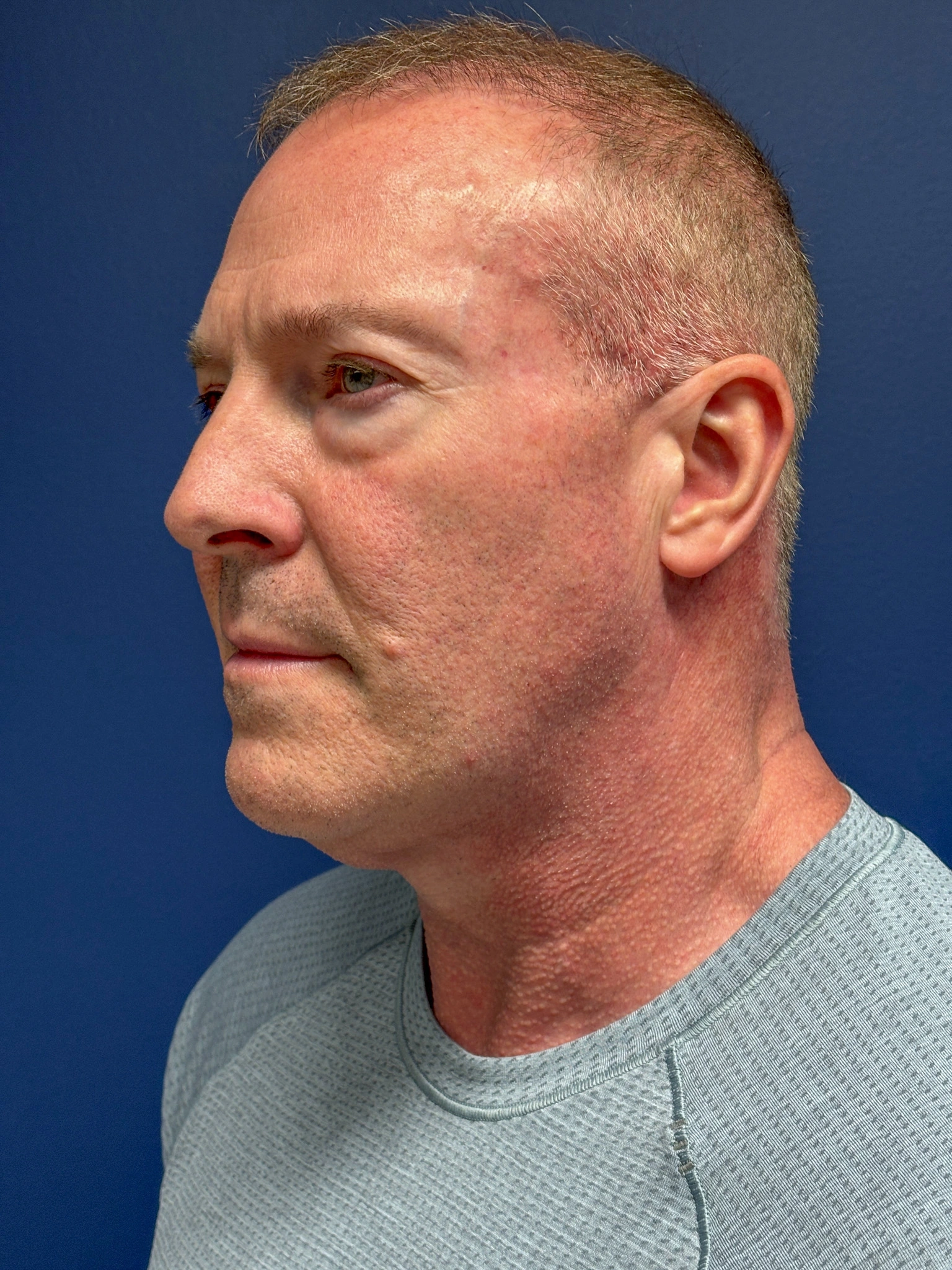 Facelift-Case--5246 | Before Facelift 4