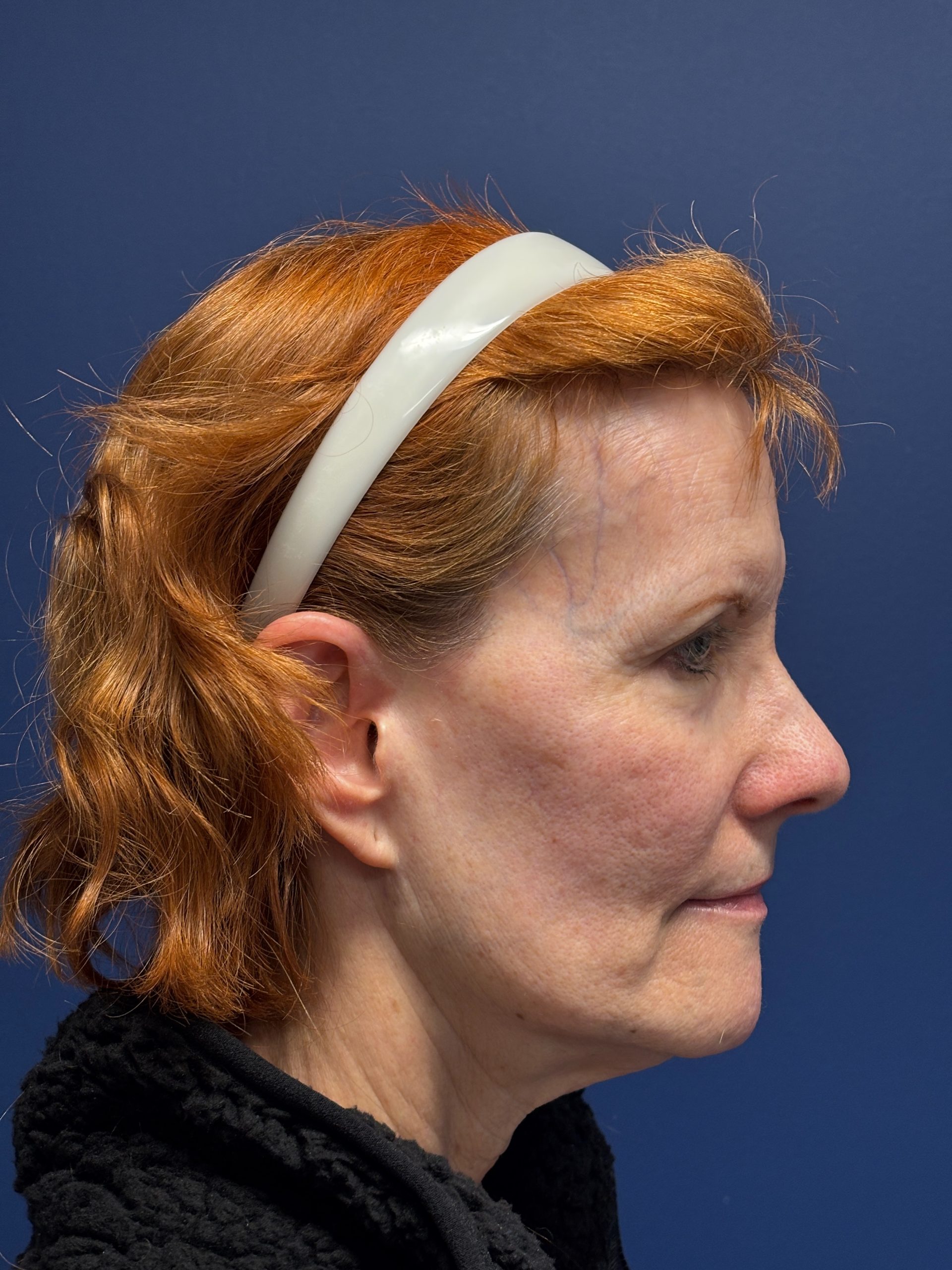 Facelift-Facial-Fat-Grafting-Neck-Lift-Case--6778 | Before Face360 3