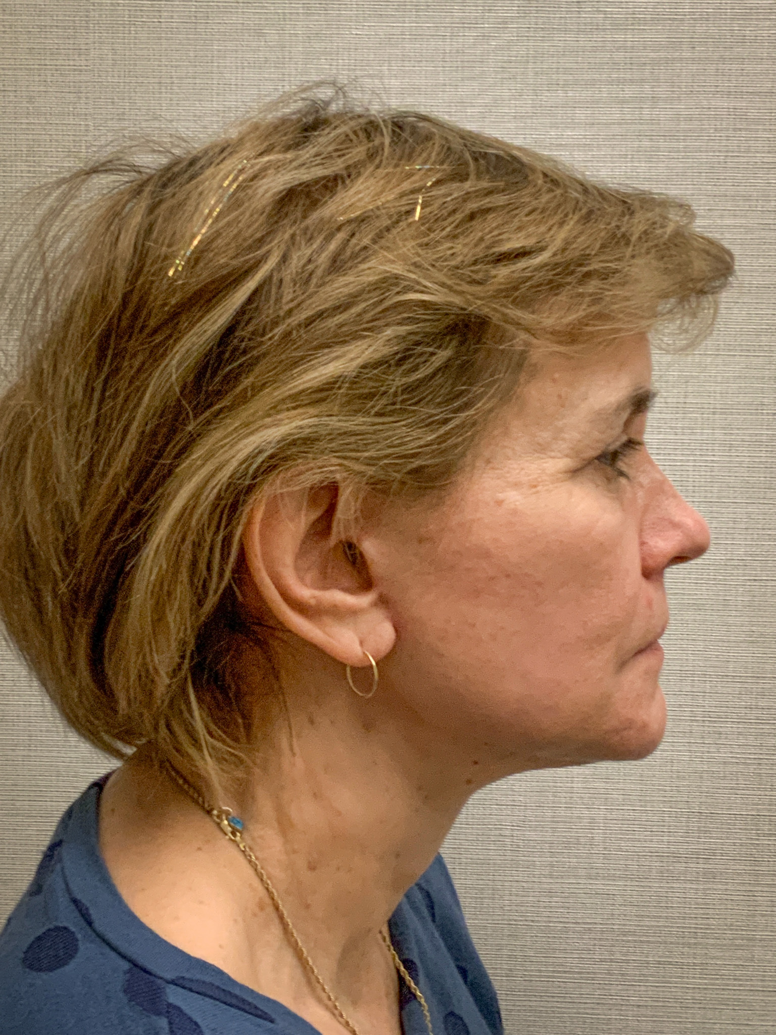 Facelift-Case--8739 | After Facelift 2