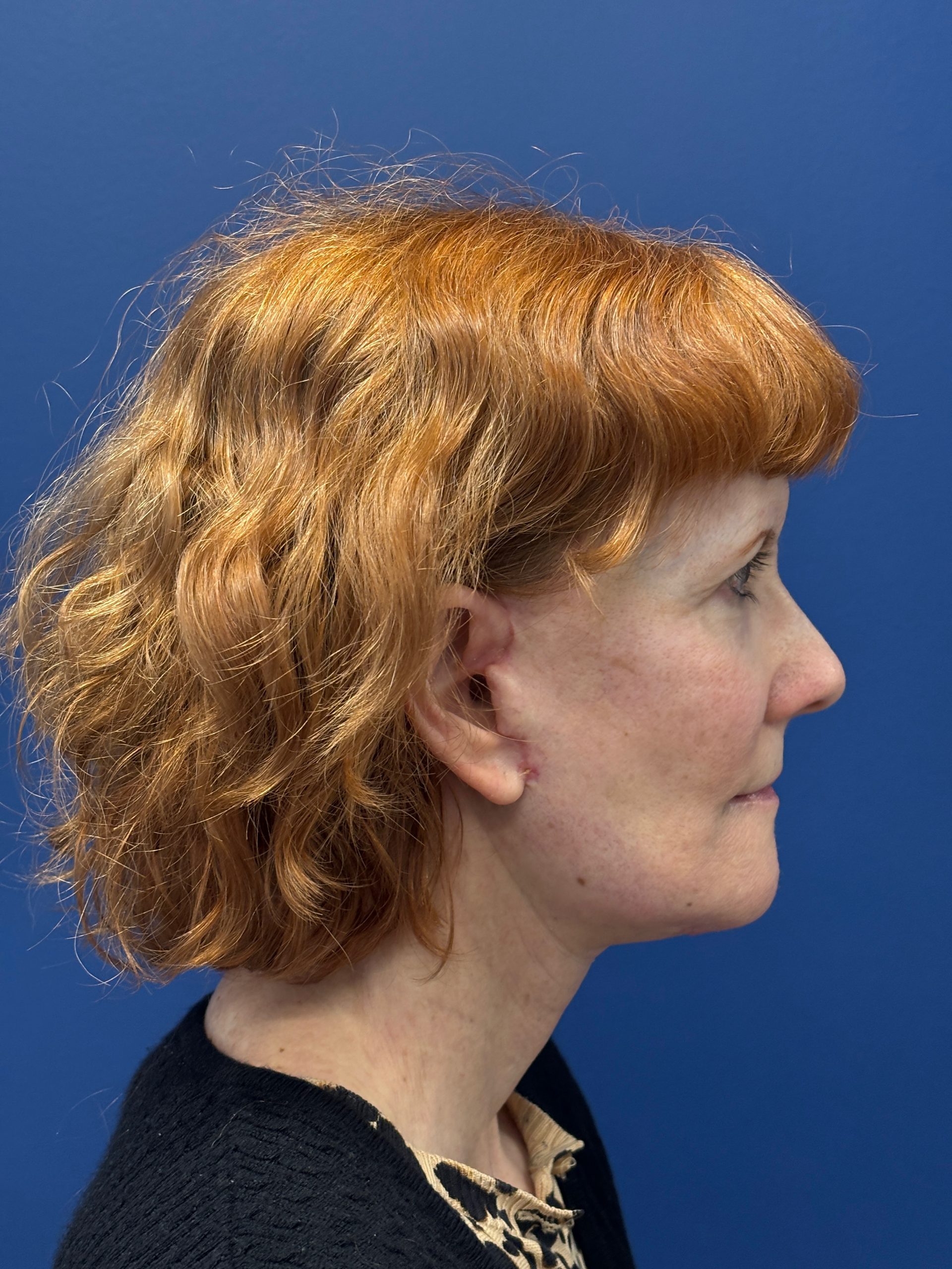 Facelift-Facial-Fat-Grafting-Neck-Lift-Case--6778 | After Face360 3