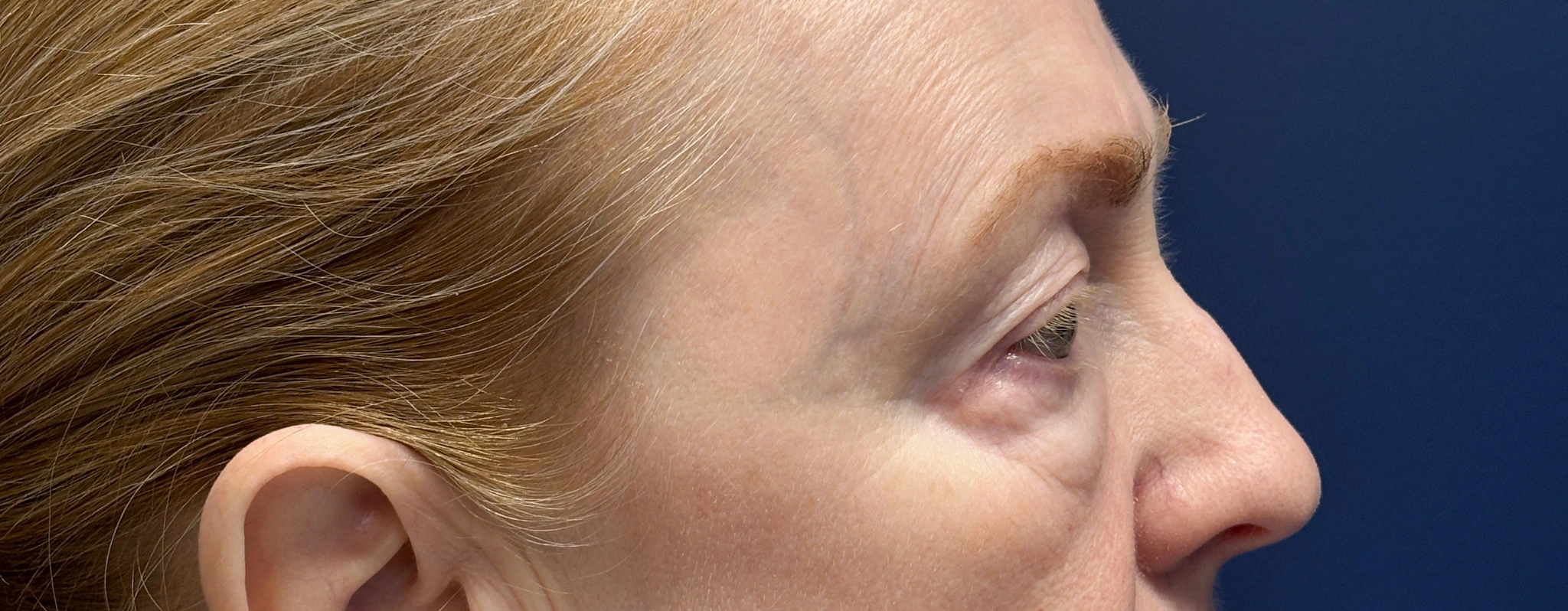 Blepharoplasty-Case--2019 | Before Eyelid Surgery 2