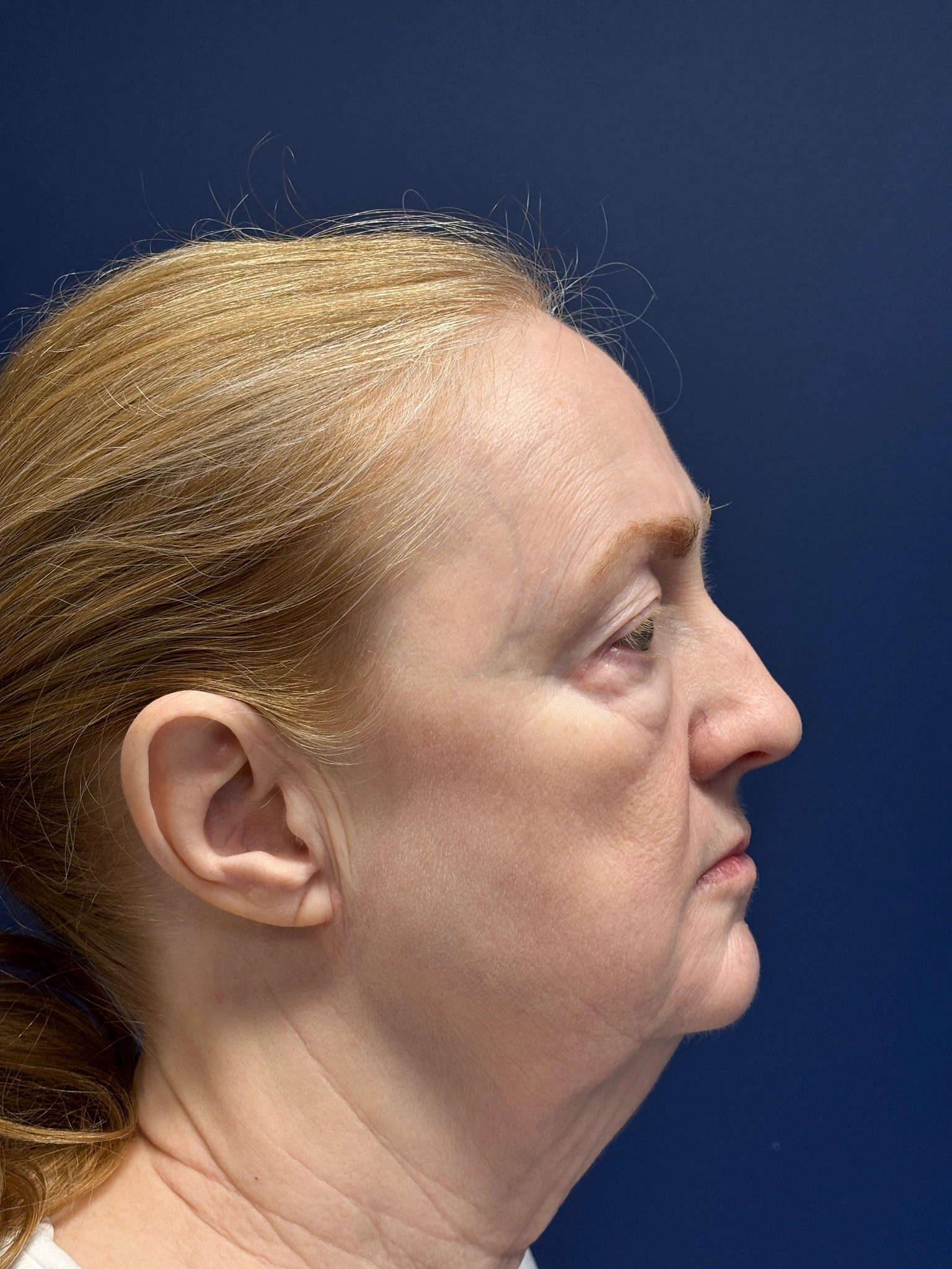 Facelift-and-Facial-Fat-Grafting-Case--3549 | Before Facelift 2