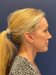 Facelift-Facial-Fat-Grafting-Brow-and-Neck-Lift-Case--9593 | After Facial Fat Grafting 2