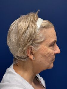 Facelift-Case--3746 | Before Dr. Frank Albino 2