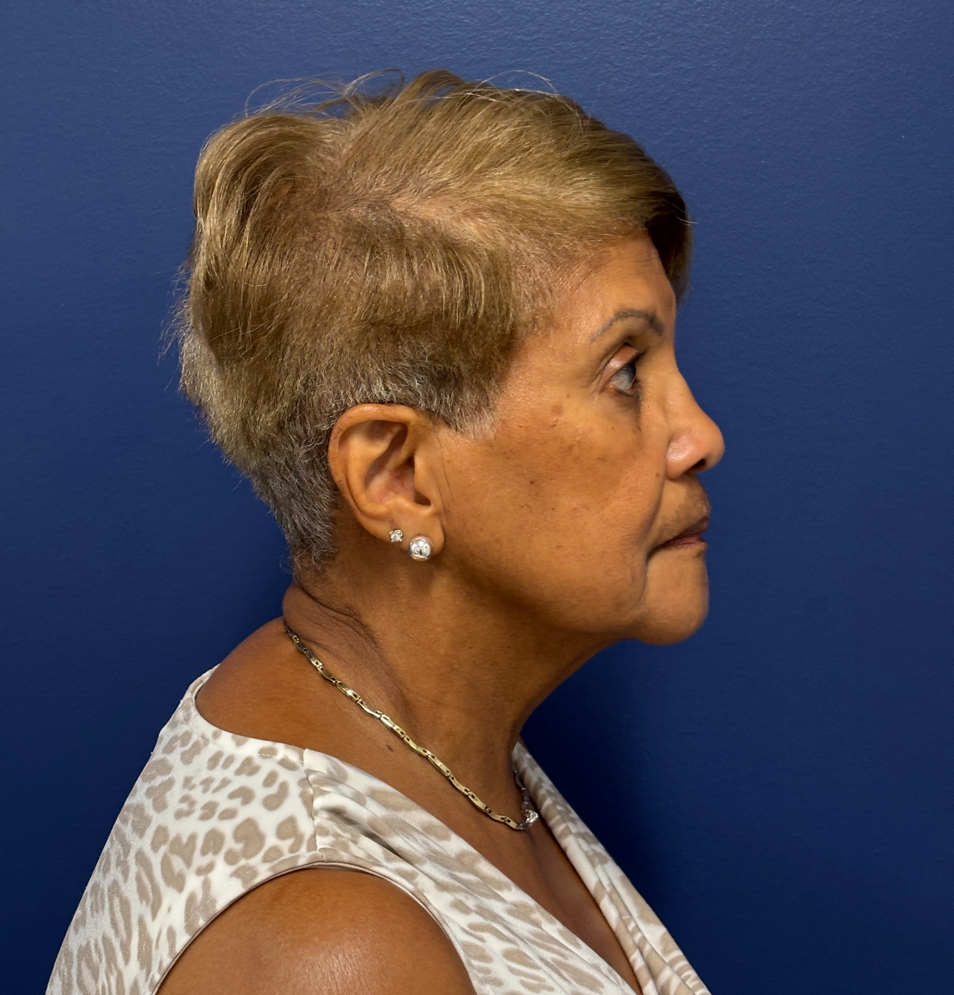Facelift-Facial-Fat-Graft-Neck-Lift-Case--4262 | Before Face360 2