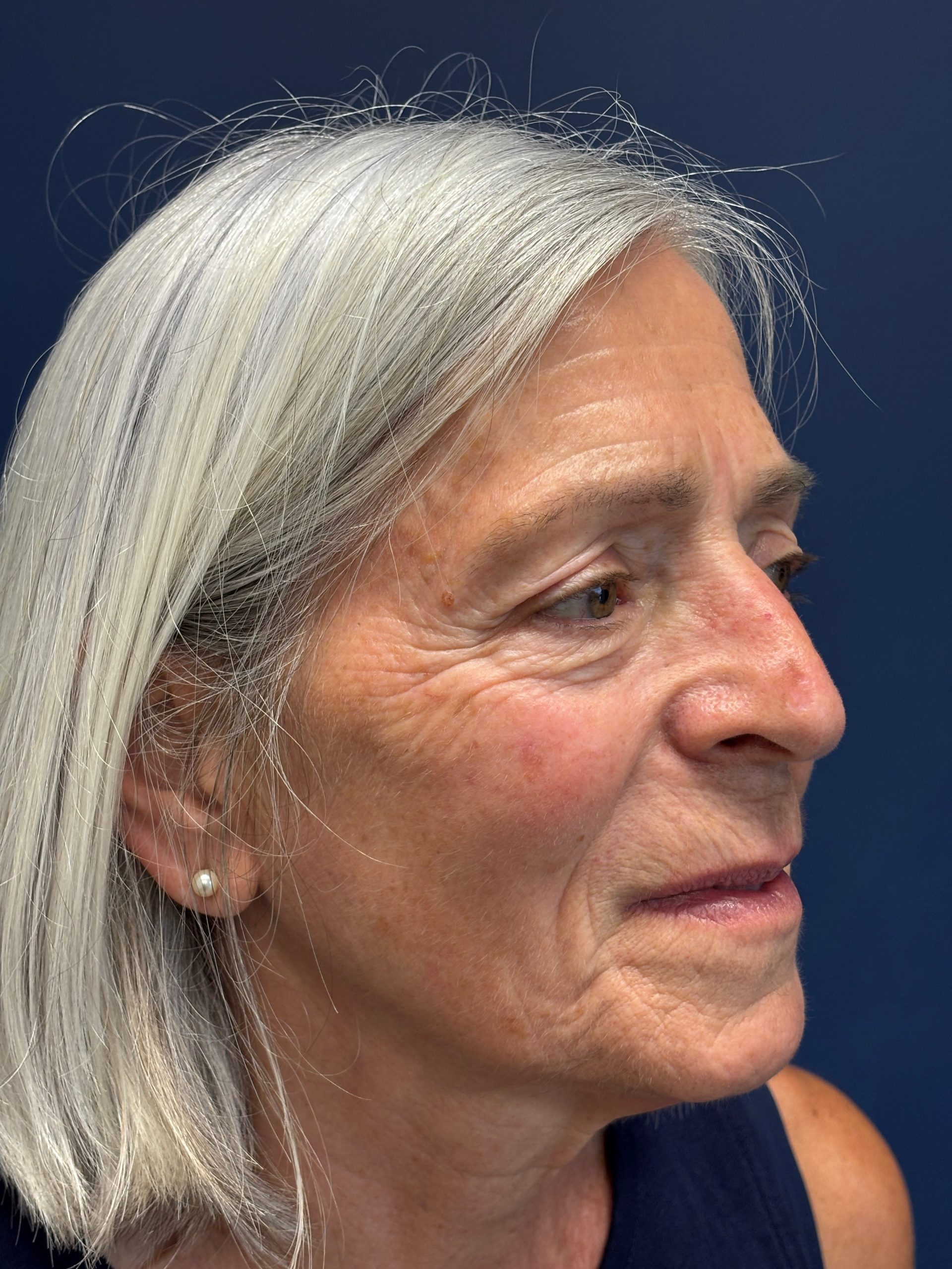 Facelift-Facial-Fat-Grafting-Browlift-Blepharoplasty-Necklift-Case--4176 | Before Brow Lift 3