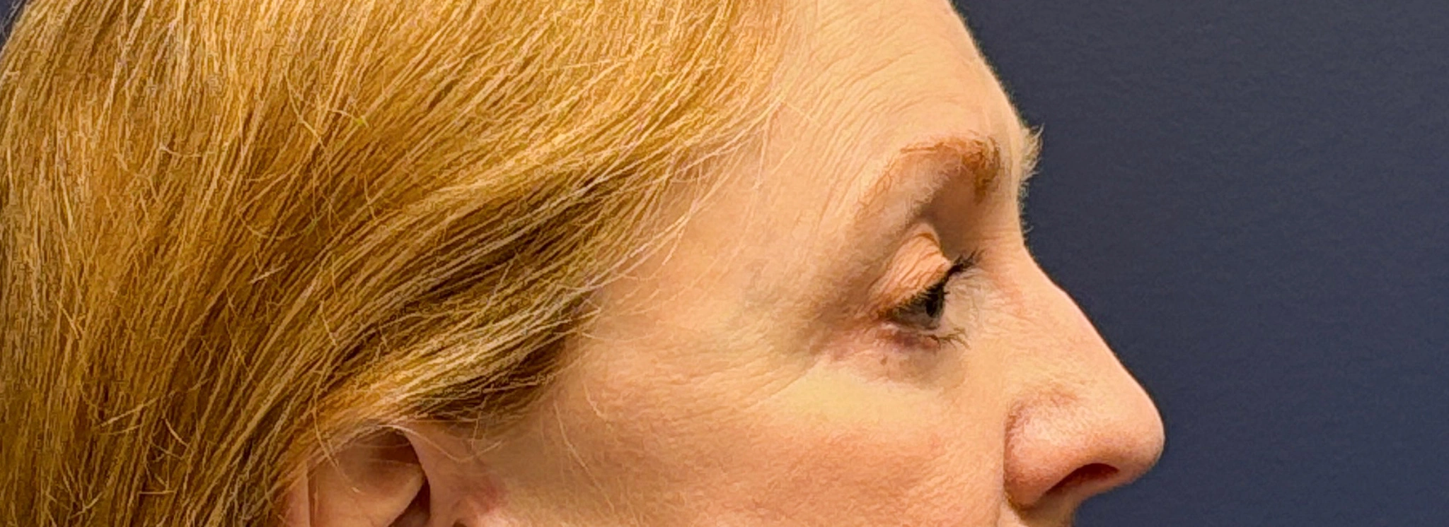 Blepharoplasty-Case--2019 | After Eyelid Surgery 2