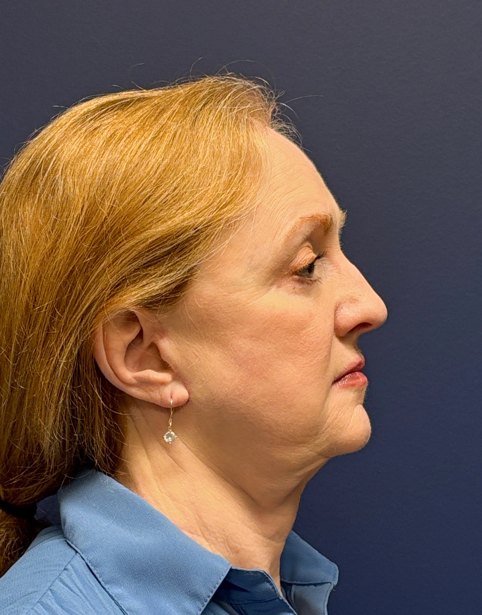 Facelift-and-Facial-Fat-Grafting-Case--3549 | After Facelift 2