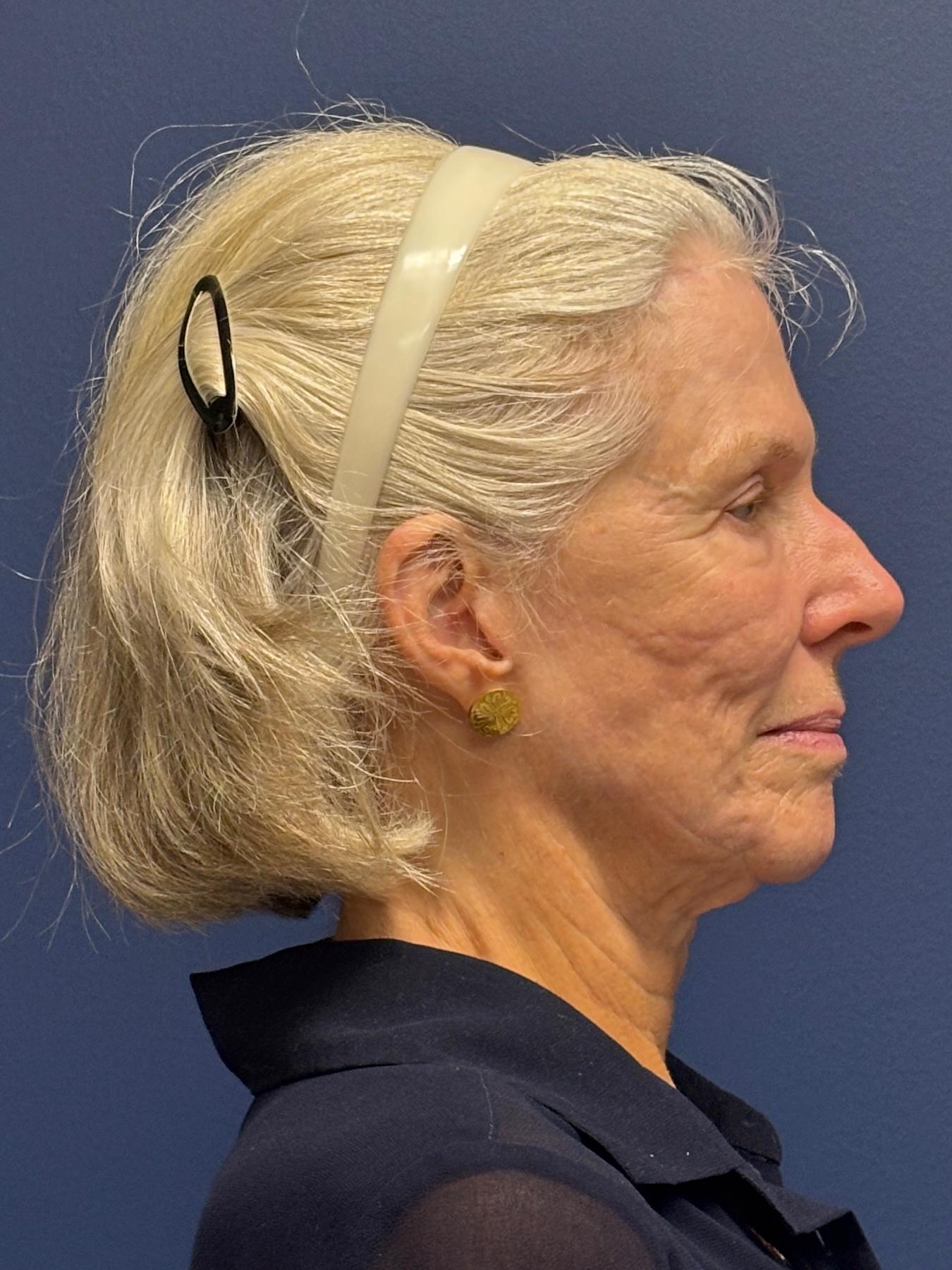 Facelift-Facial-Fat-Grafting-Neck-Lift-Case--1414 | Before Face360 3