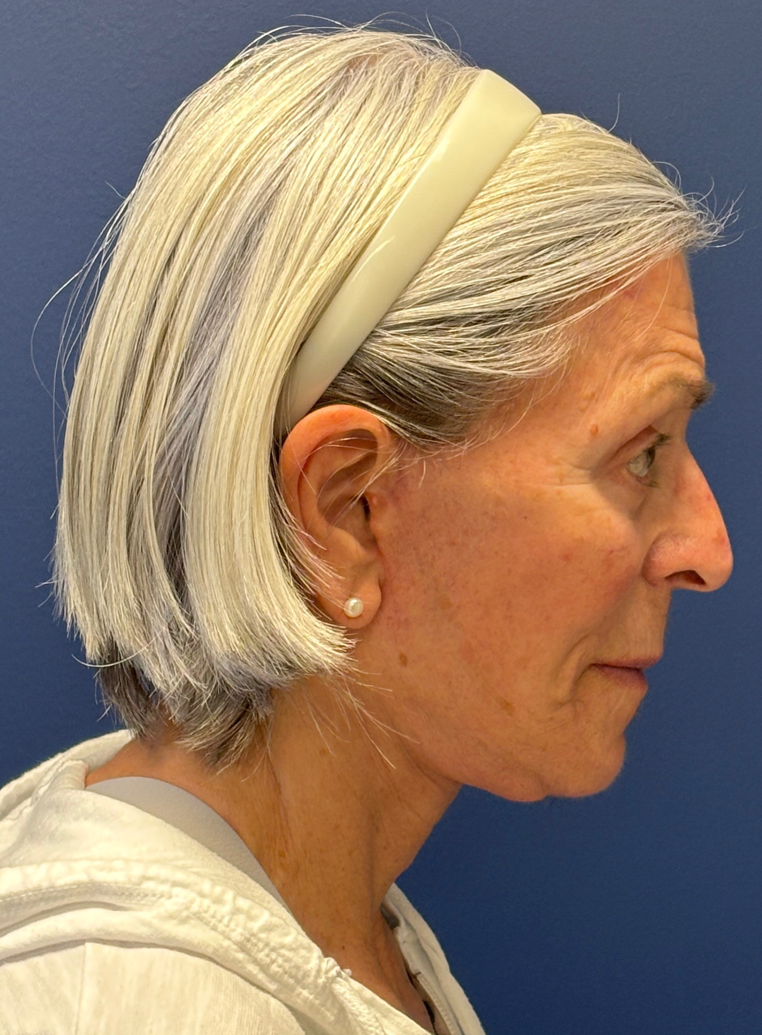 Facelift-Facial-Fat-Grafting-Browlift-Blepharoplasty-Necklift-Case--4176 | After Brow Lift 2