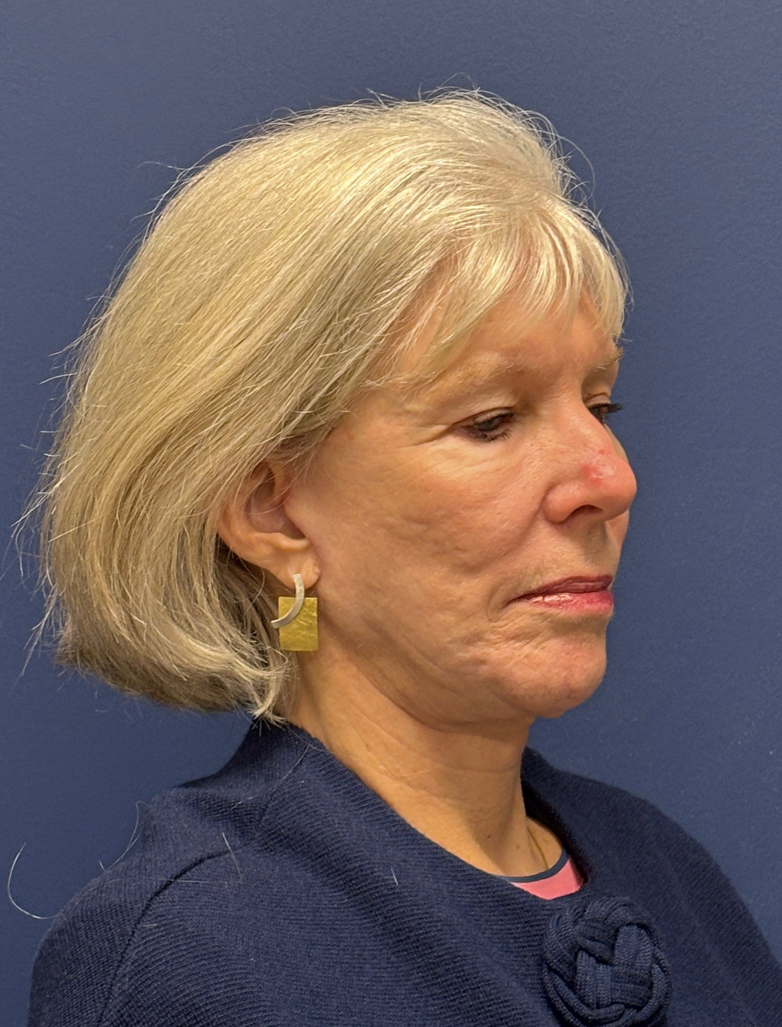 Facelift-Facial-Fat-Grafting-Neck-Lift-Case--1414 | After Face360 5