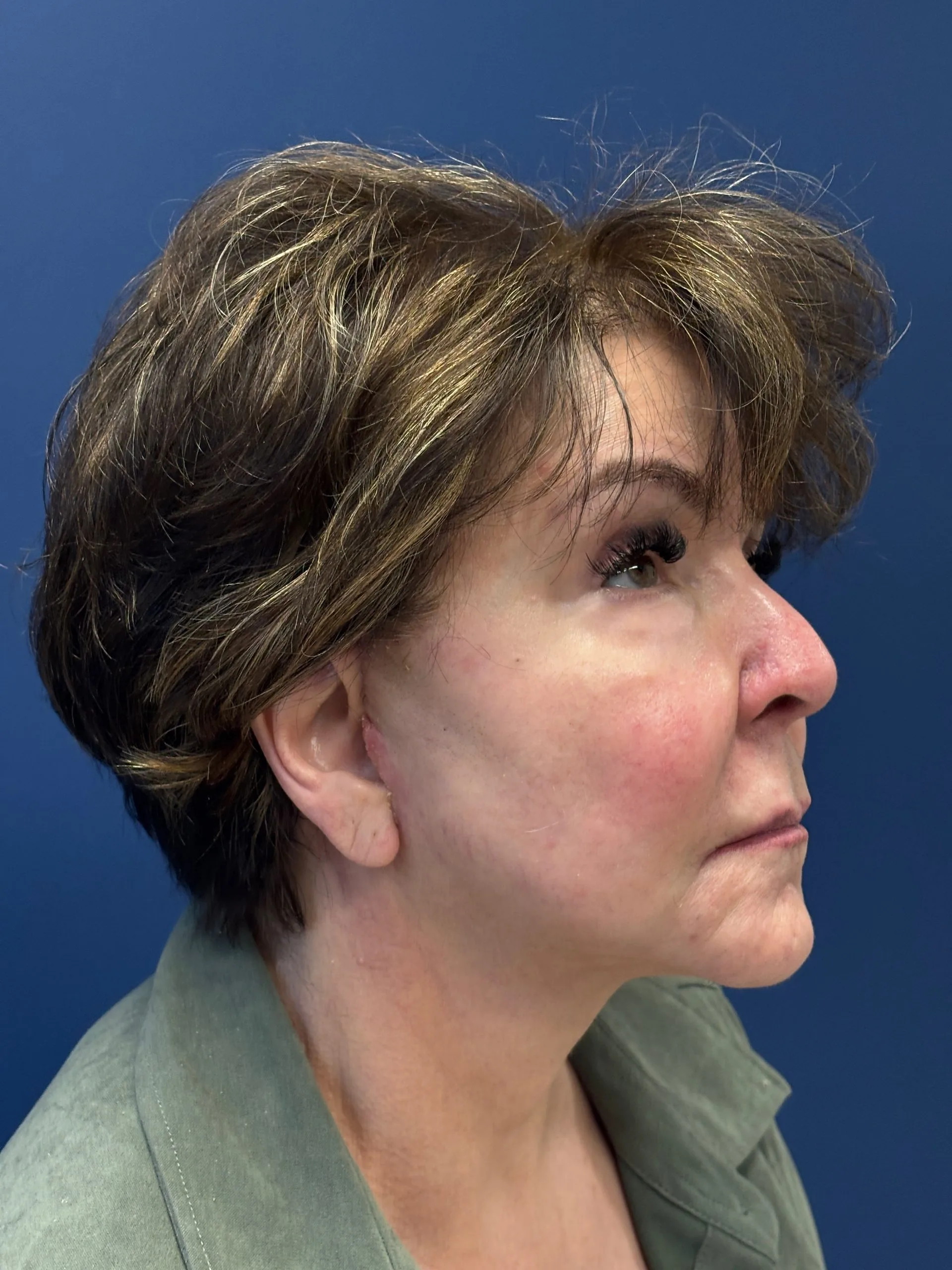 Facelift-Case--6613 | After Facelift 3